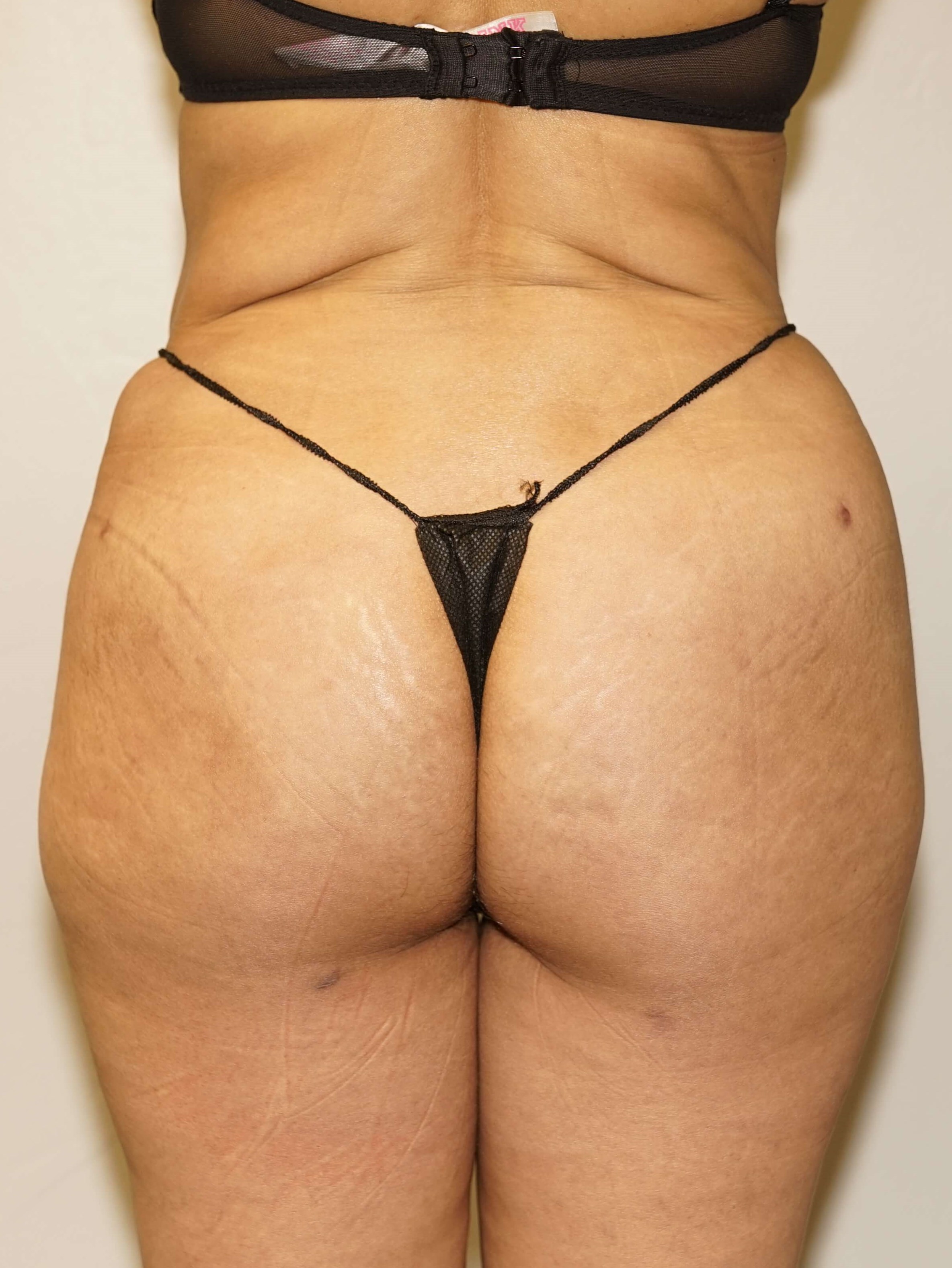 Woman has BBL Butt Lift After