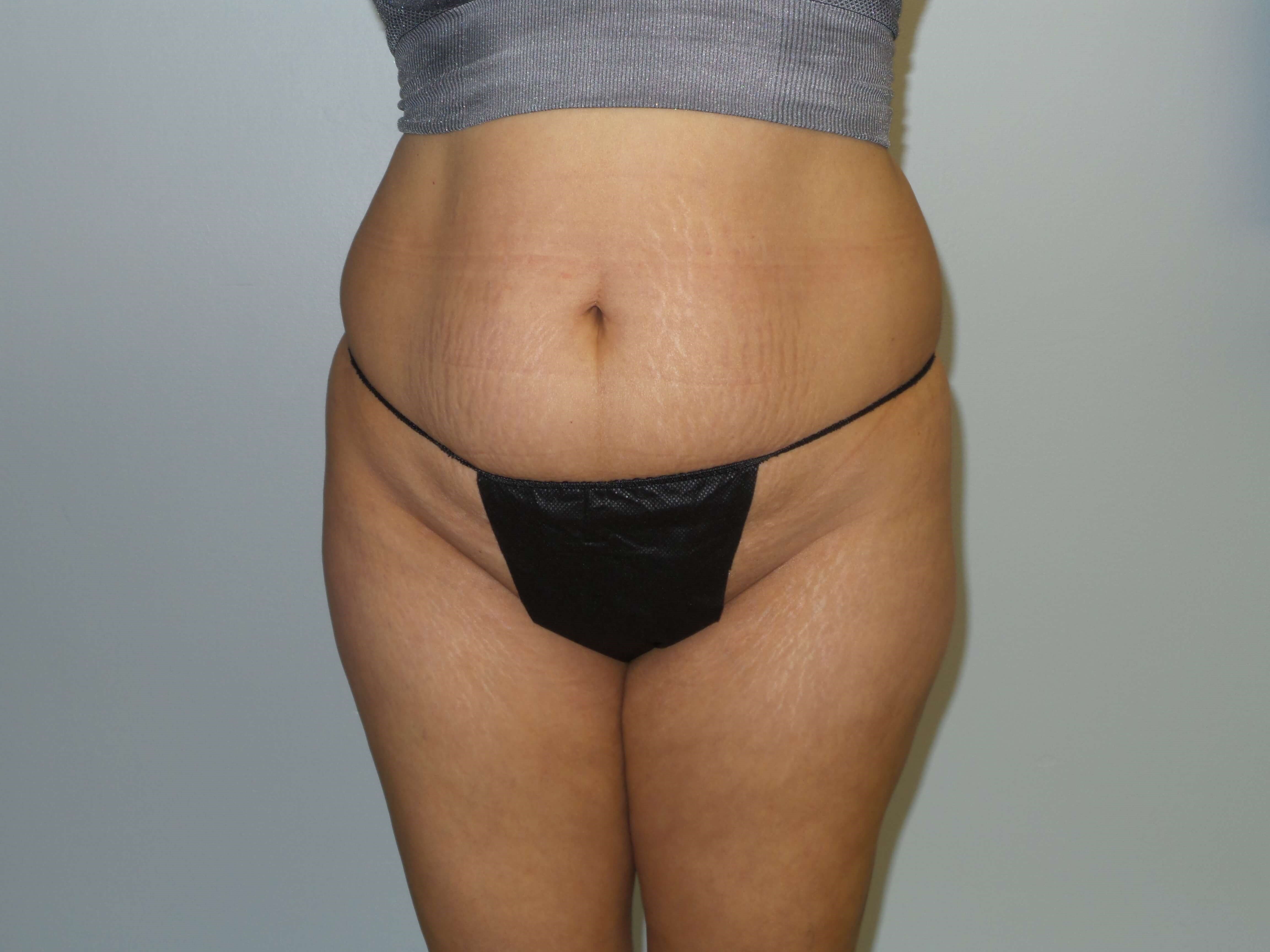 Woman has BBL Butt Lift Before