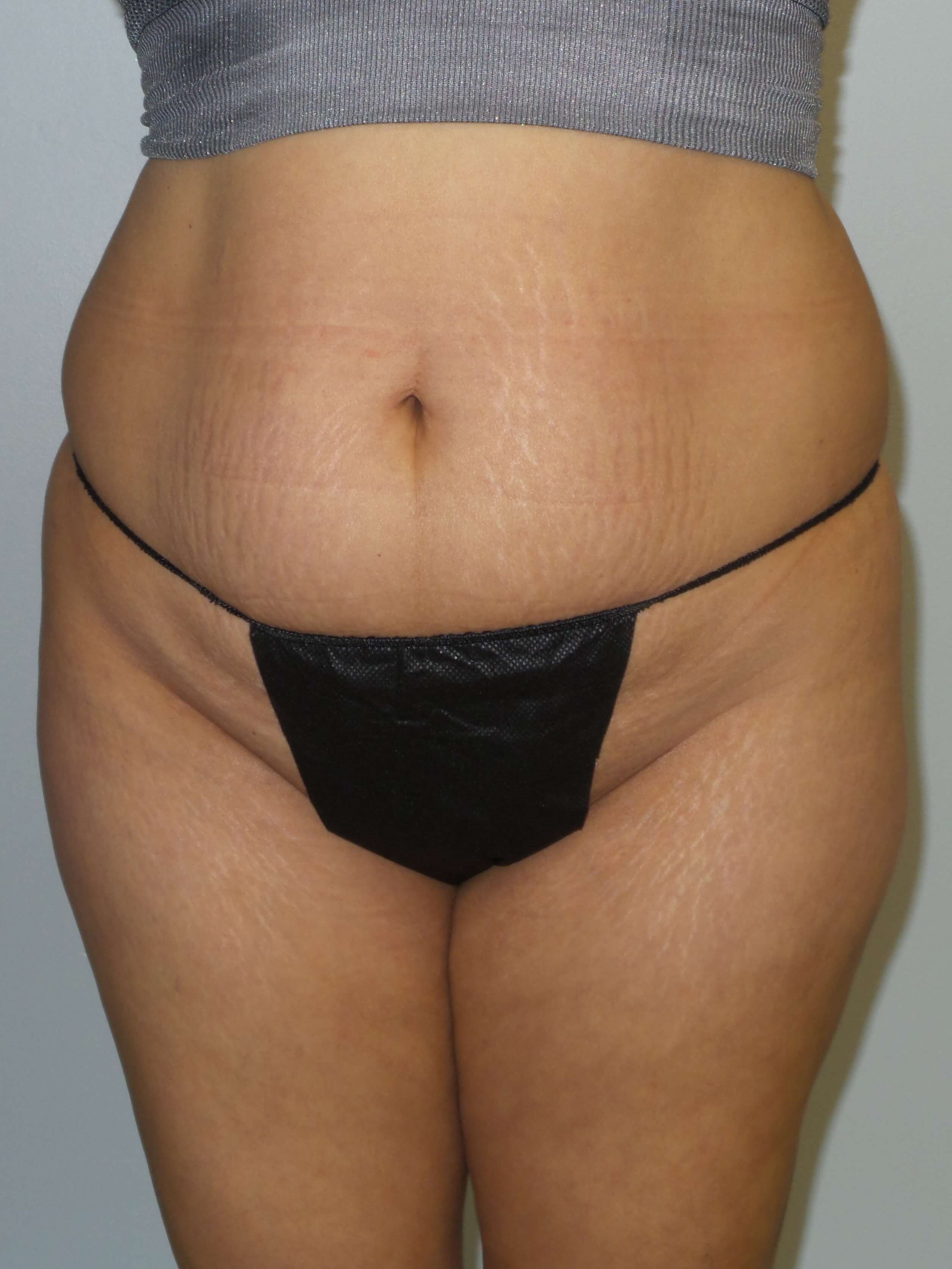 Woman has BBL Butt Lift Before