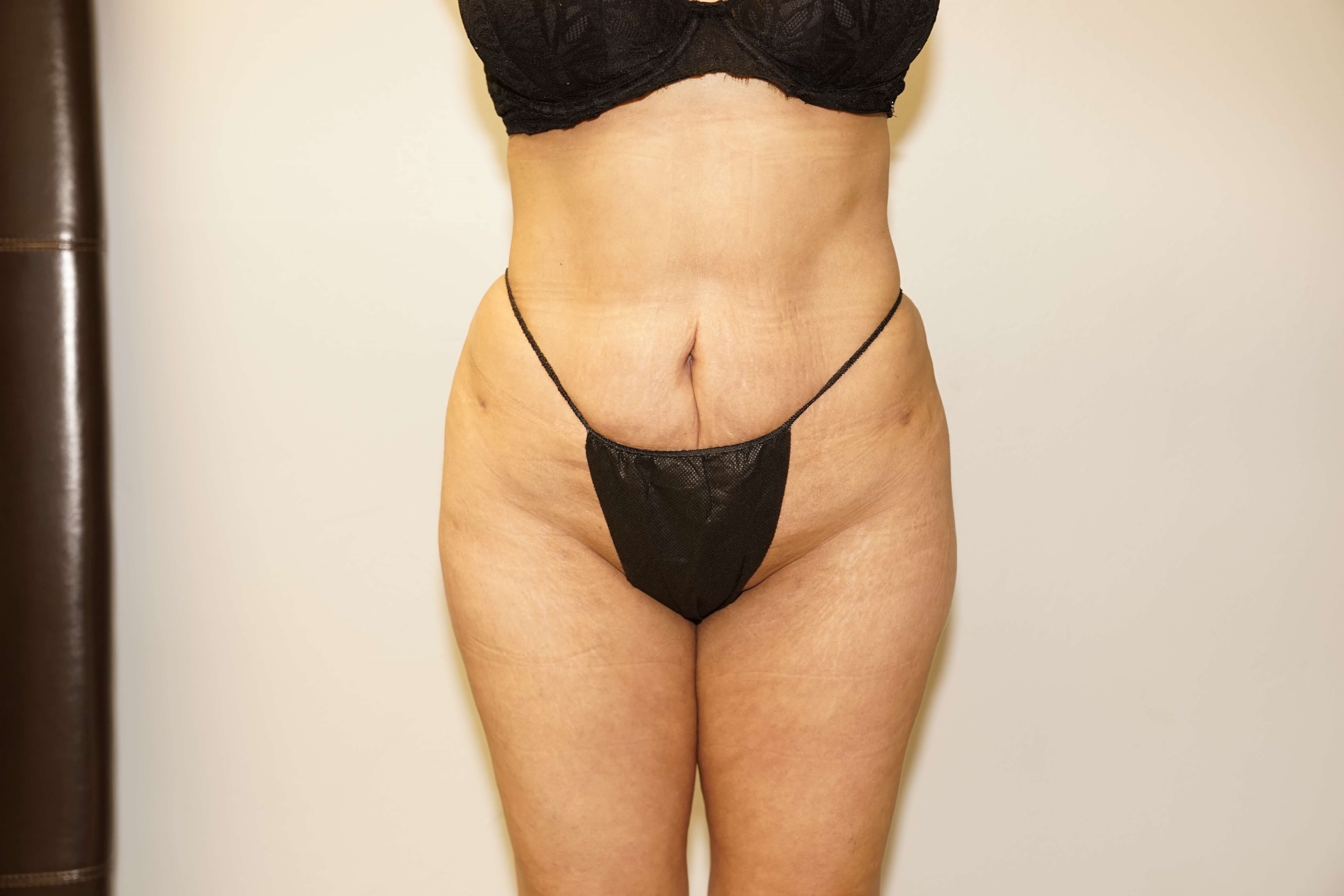 Woman has BBL Butt Lift After