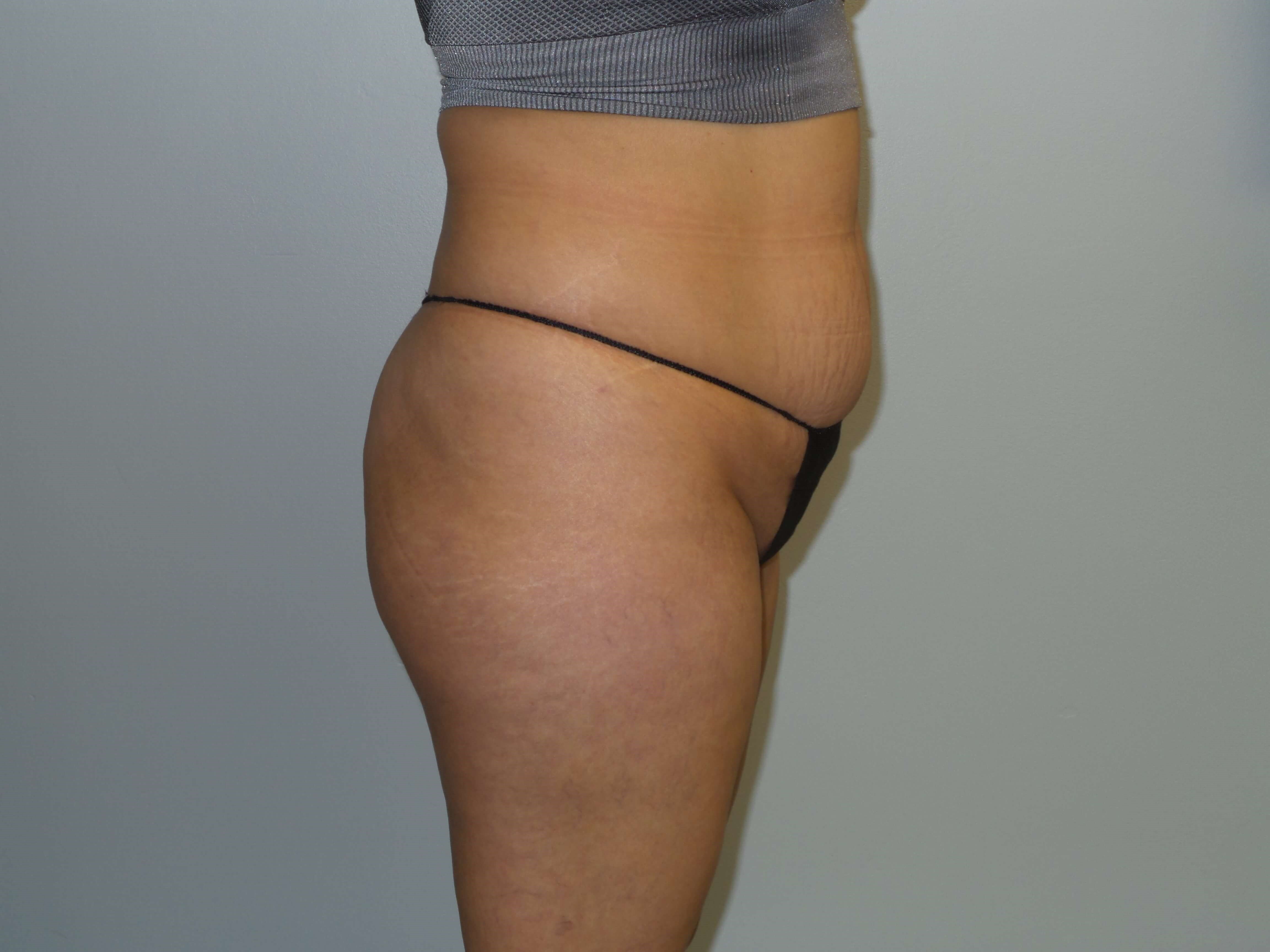 Woman has BBL Butt Lift Before