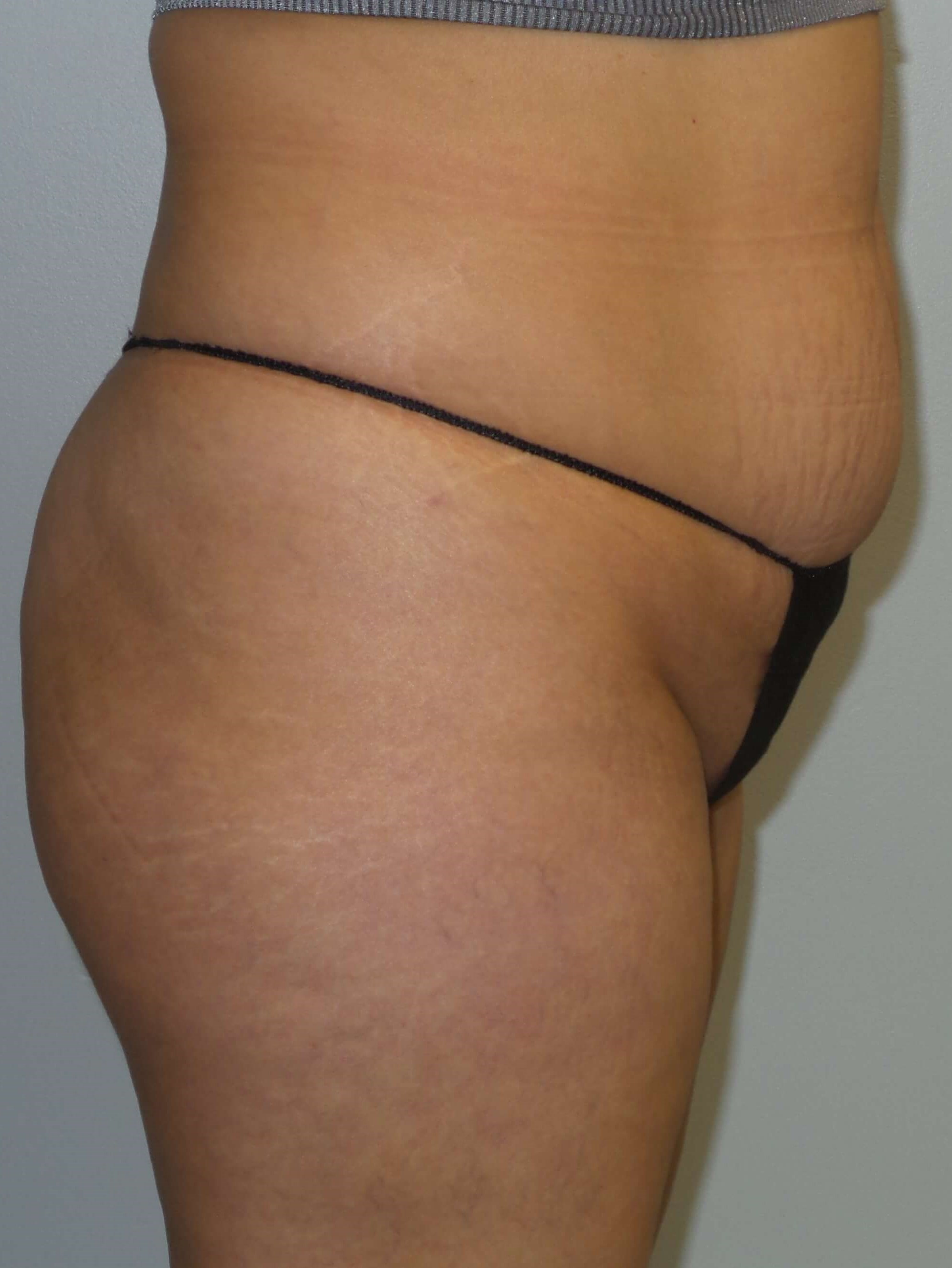 Woman has BBL Butt Lift Before