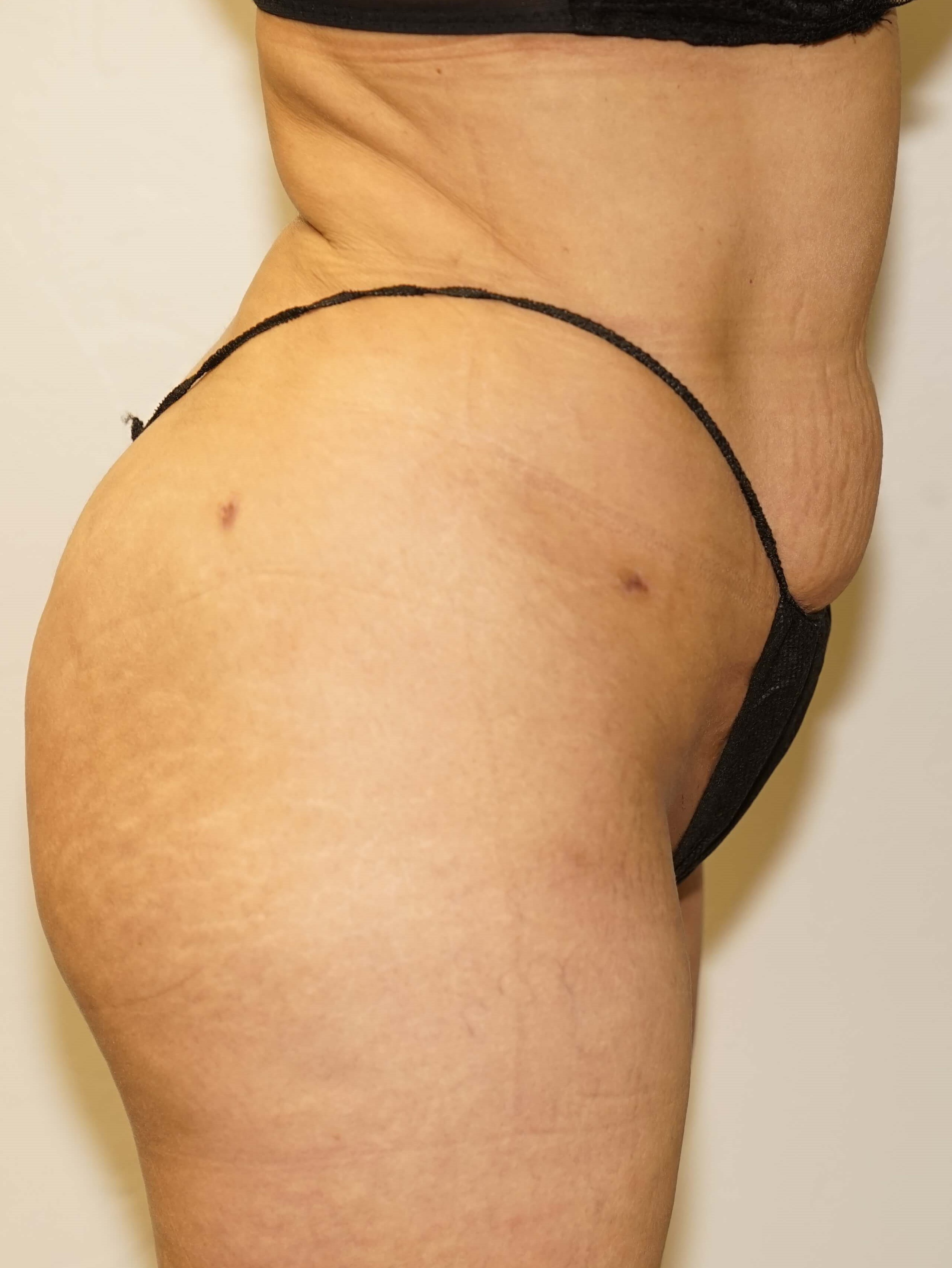Woman has BBL Butt Lift After