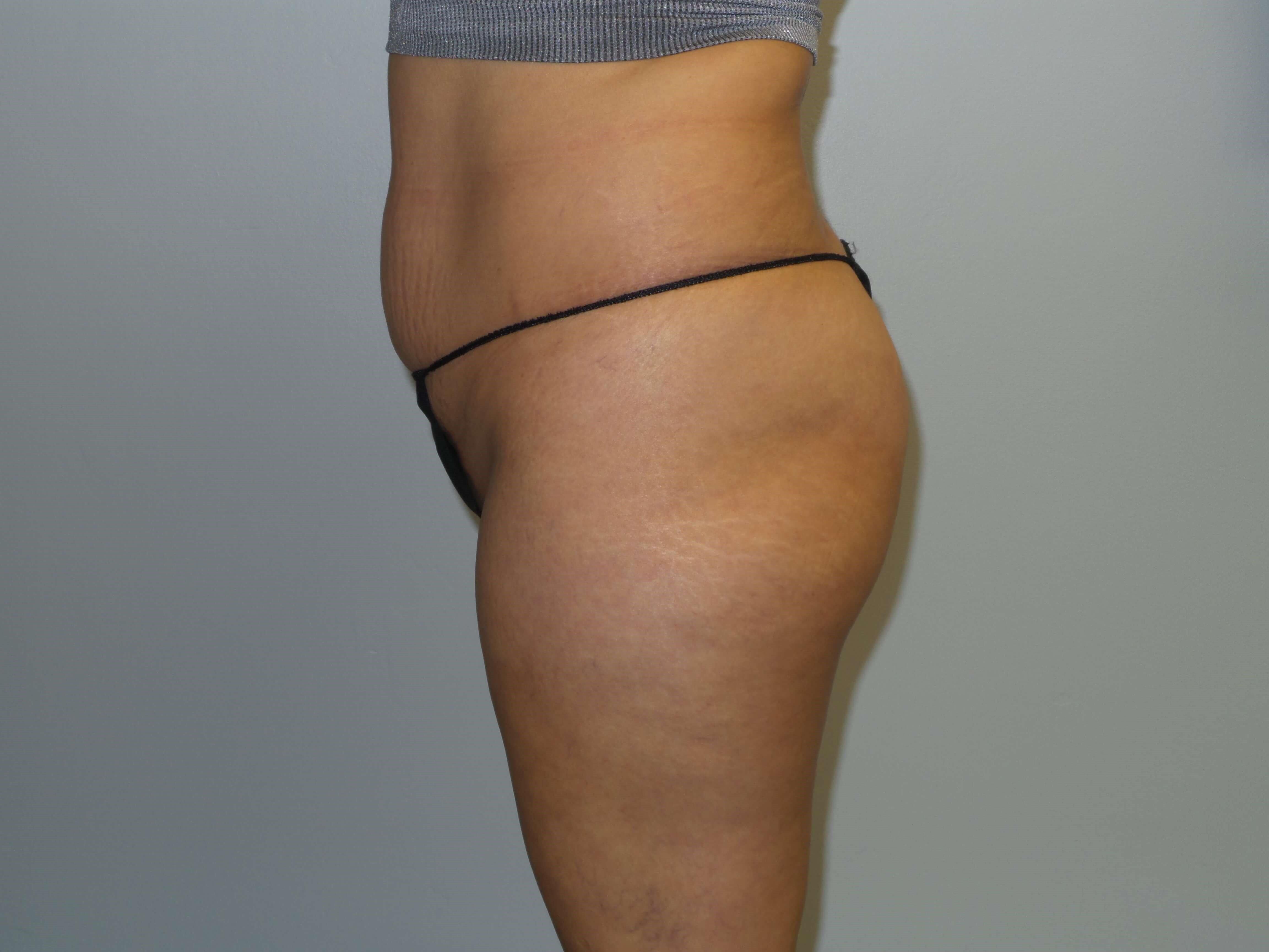 Woman has BBL Butt Lift Before