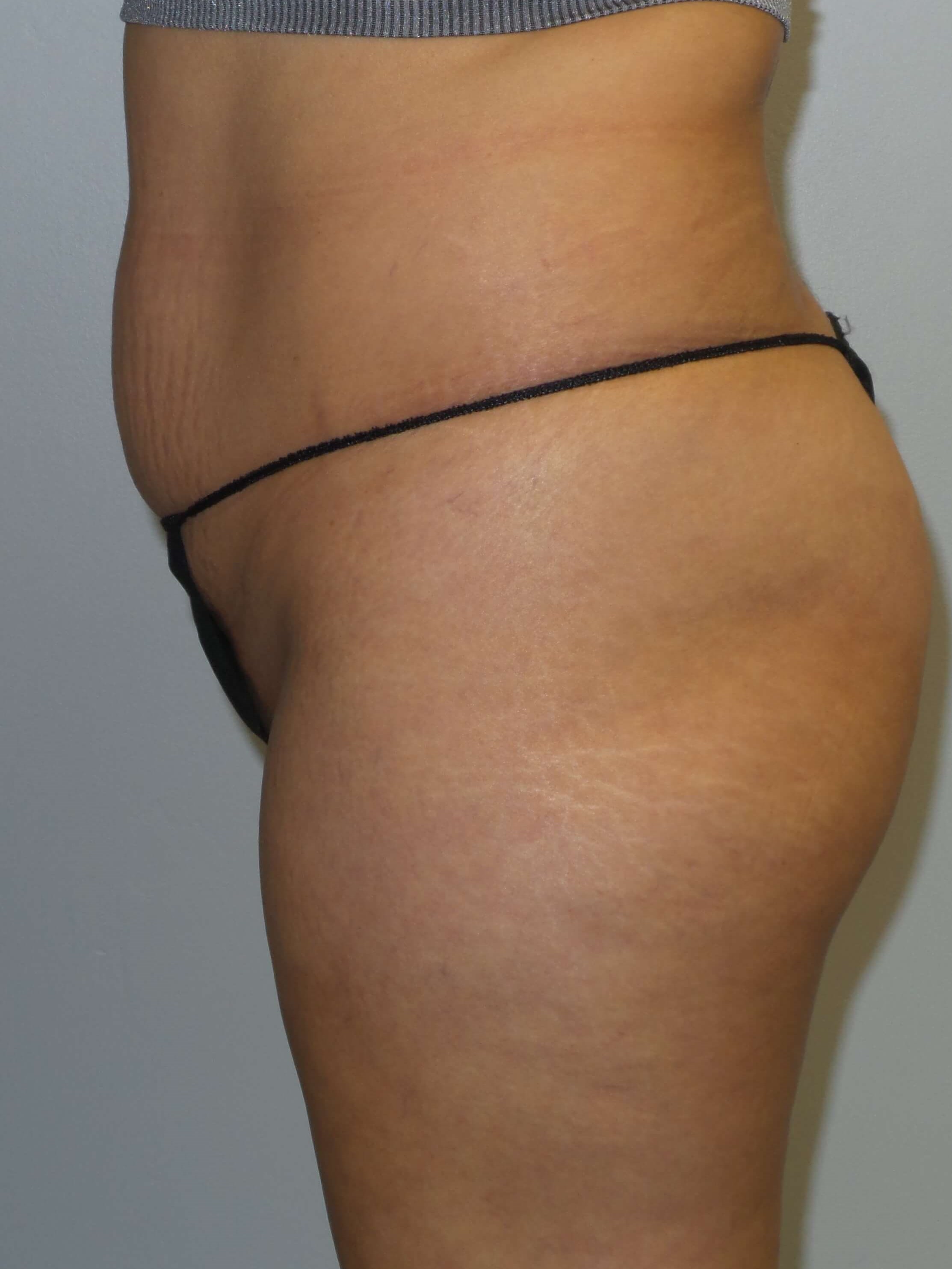 Woman has BBL Butt Lift Before