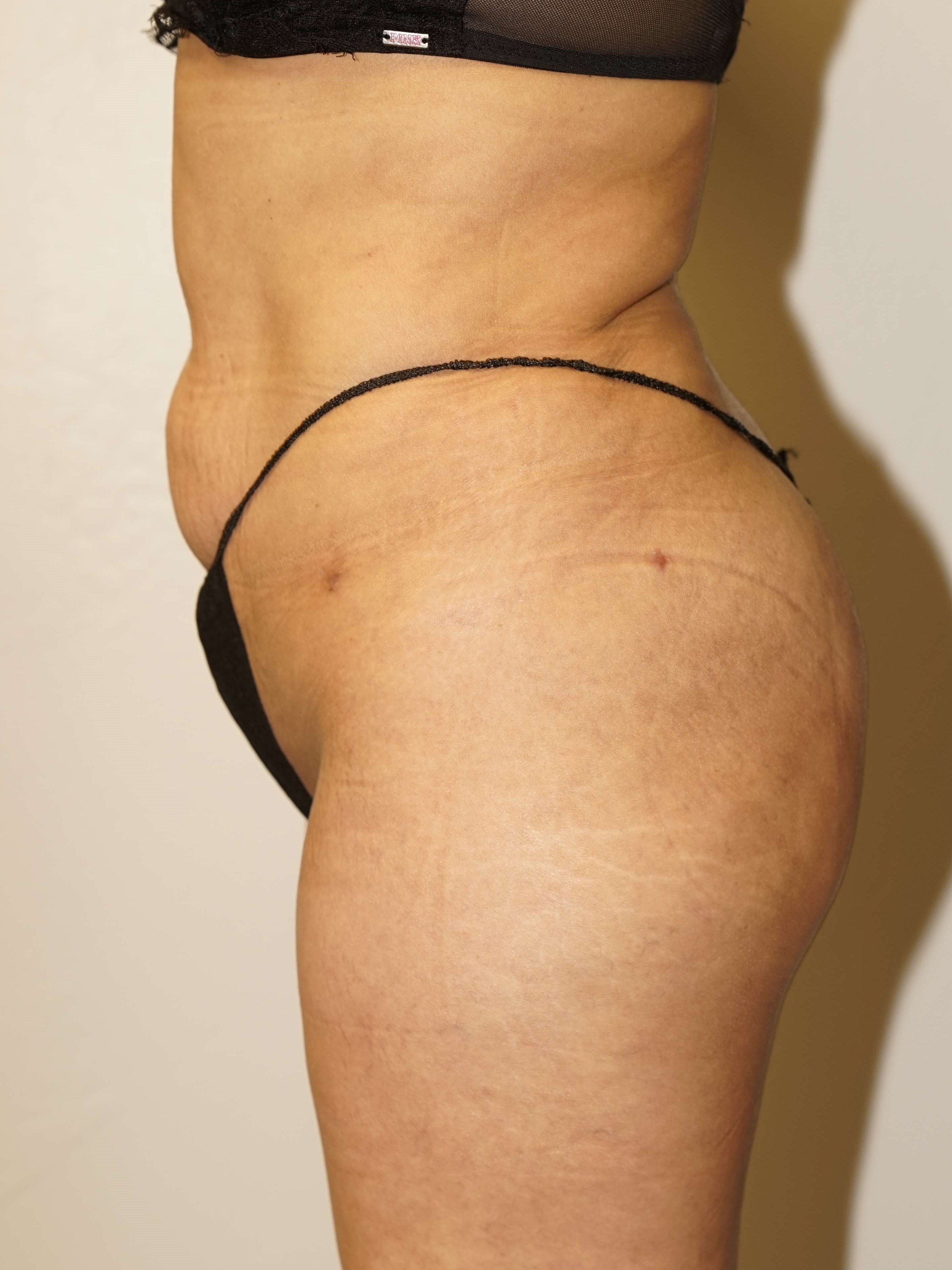 Woman has BBL Butt Lift After