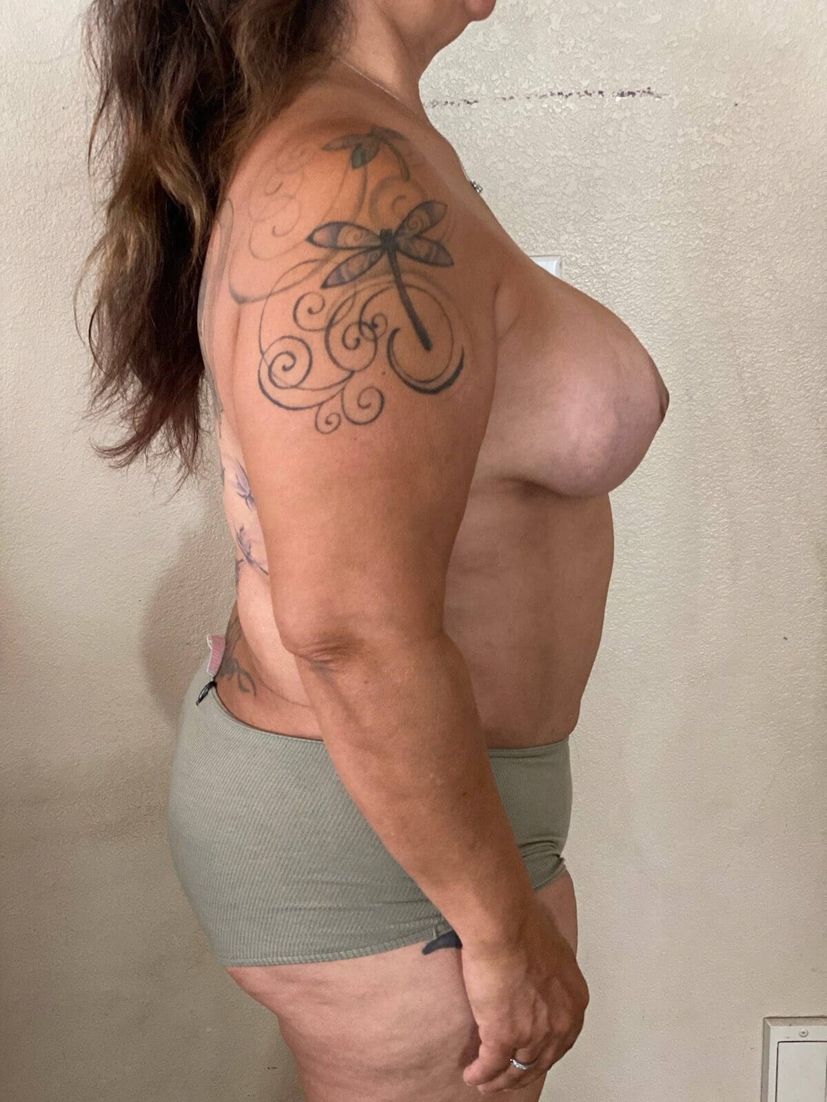 Westlake Woman Has Mastopexy After