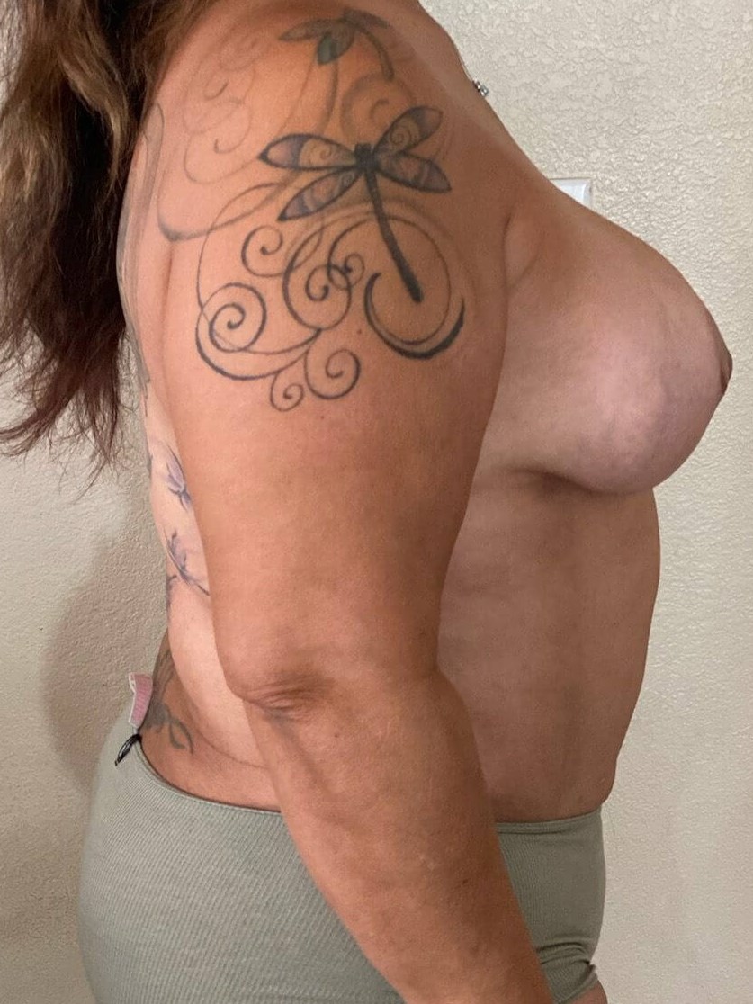 Westlake Woman Has Mastopexy After
