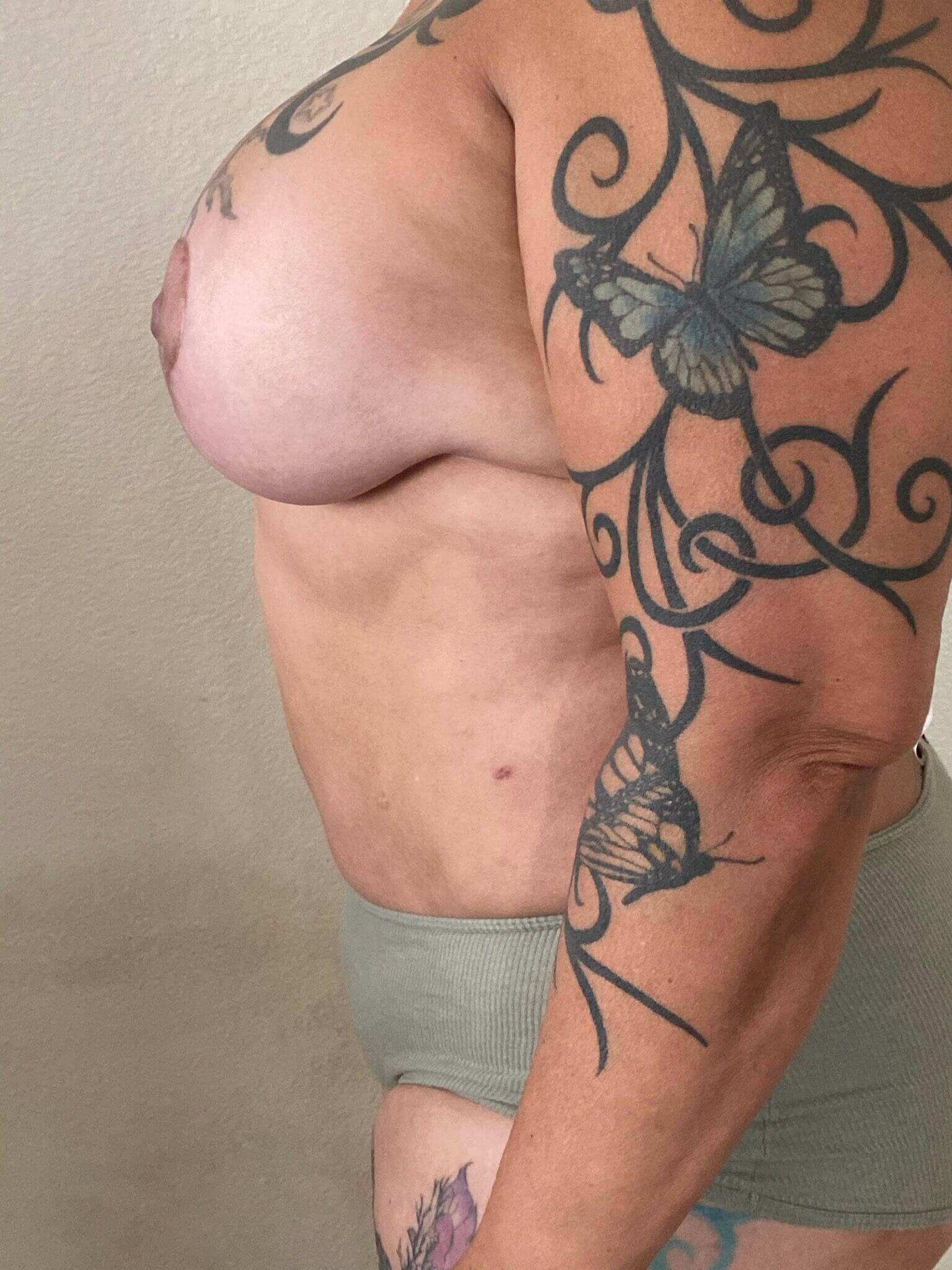 Westlake Woman Has Mastopexy After
