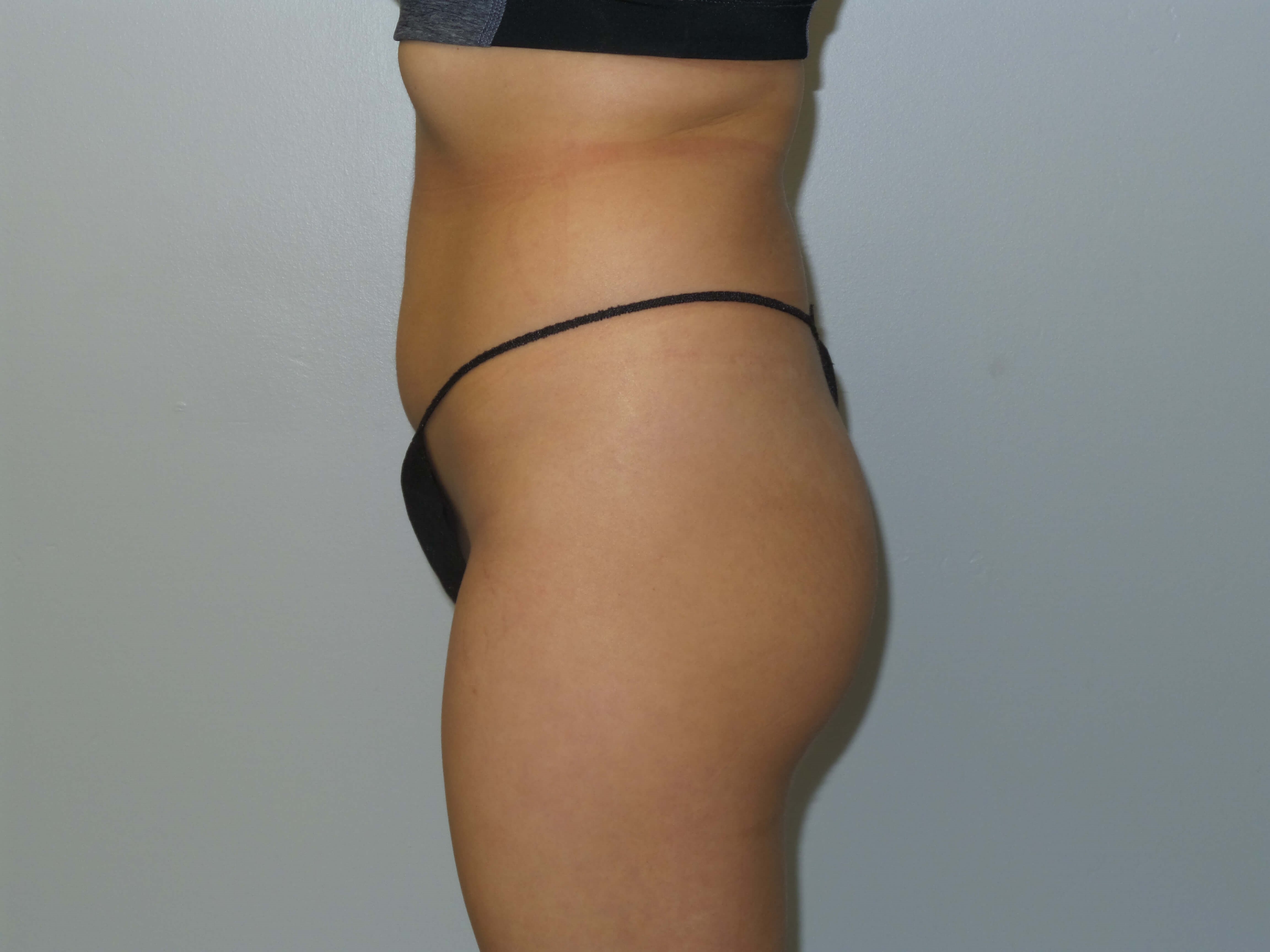 Woman has BBL Butt Lift Before