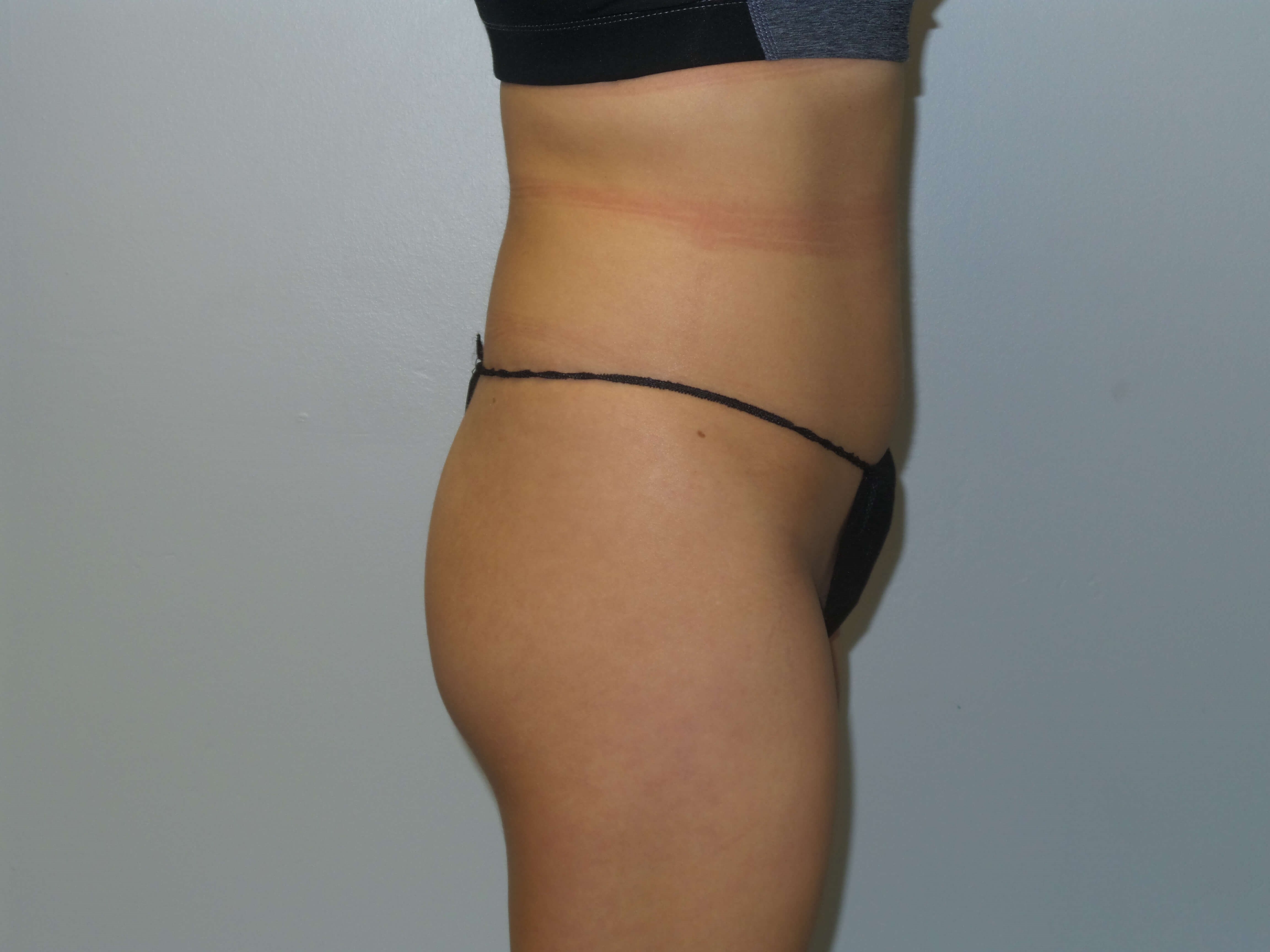 Woman has BBL Butt Lift Before