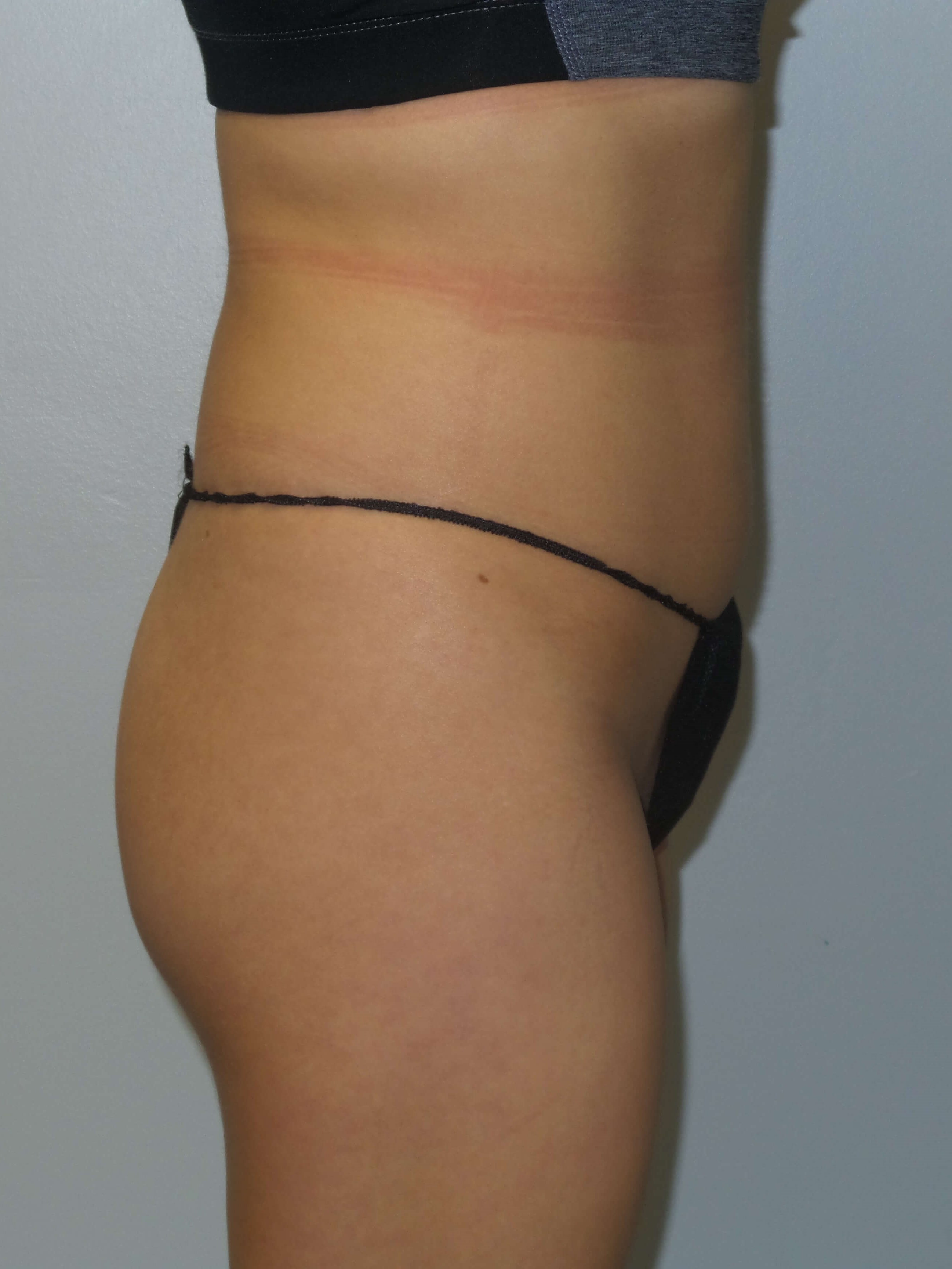 Woman has BBL Butt Lift Before