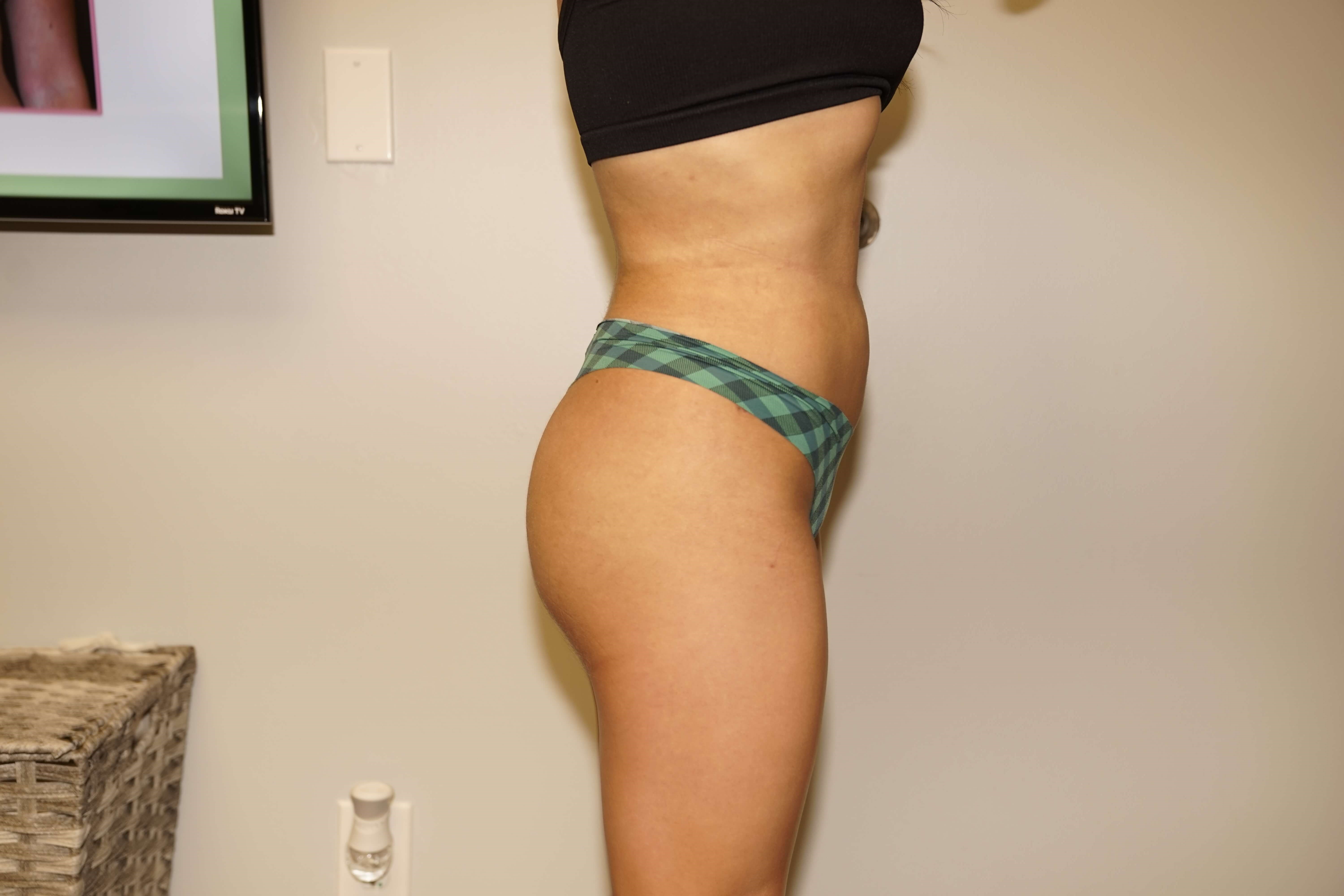 Woman has BBL Butt Lift After