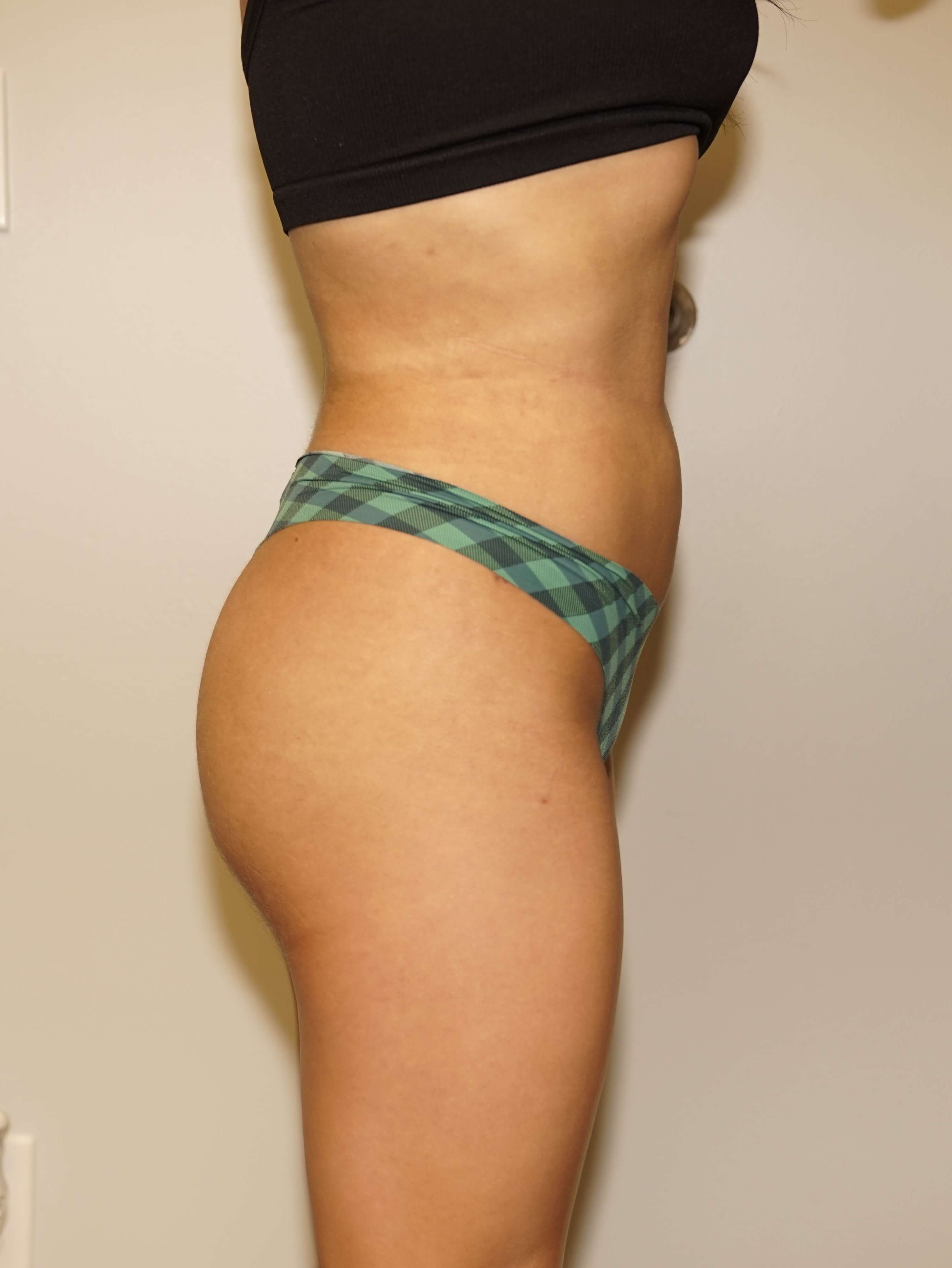 Woman has BBL Butt Lift After