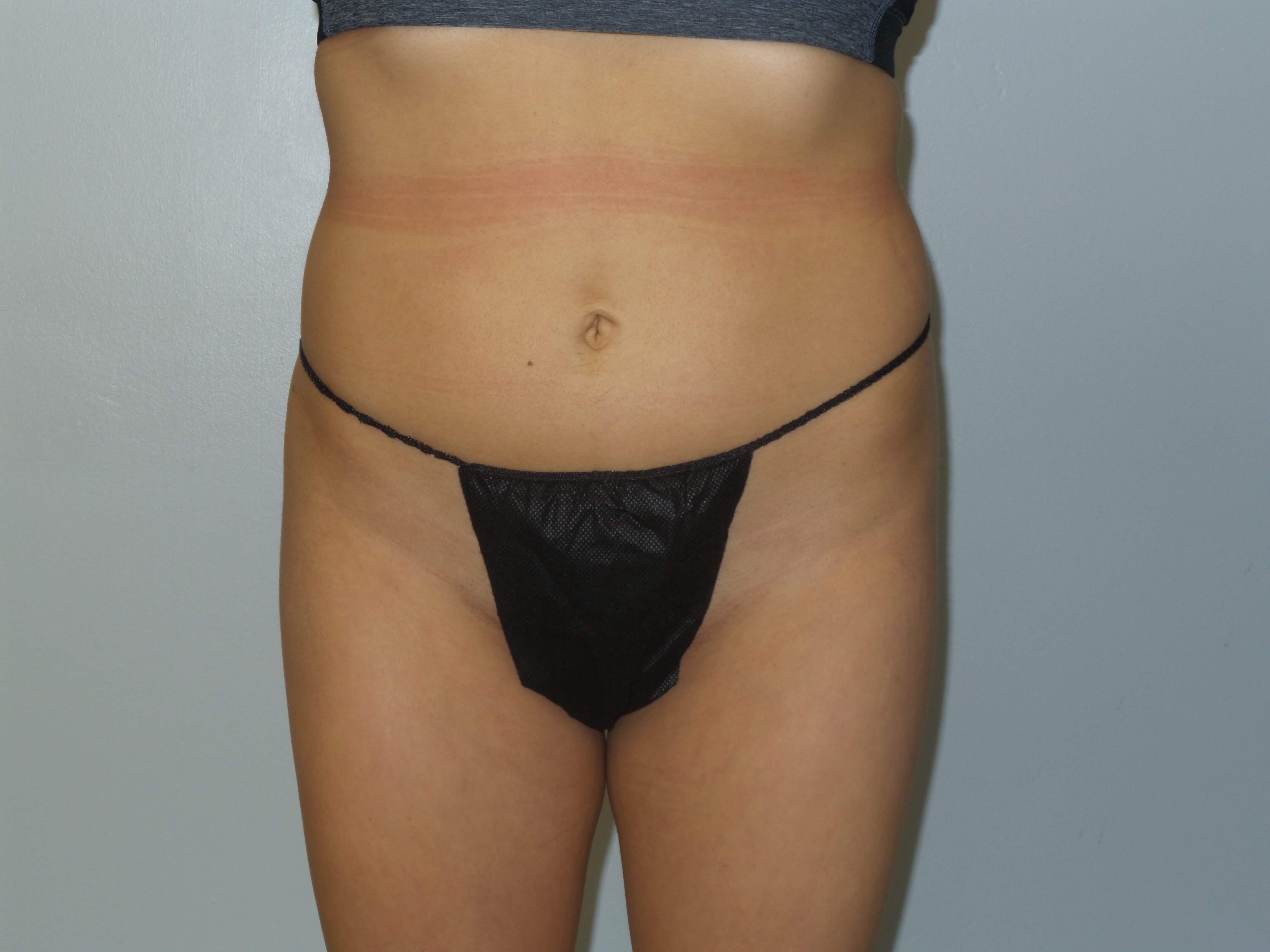 Woman has BBL Butt Lift Before