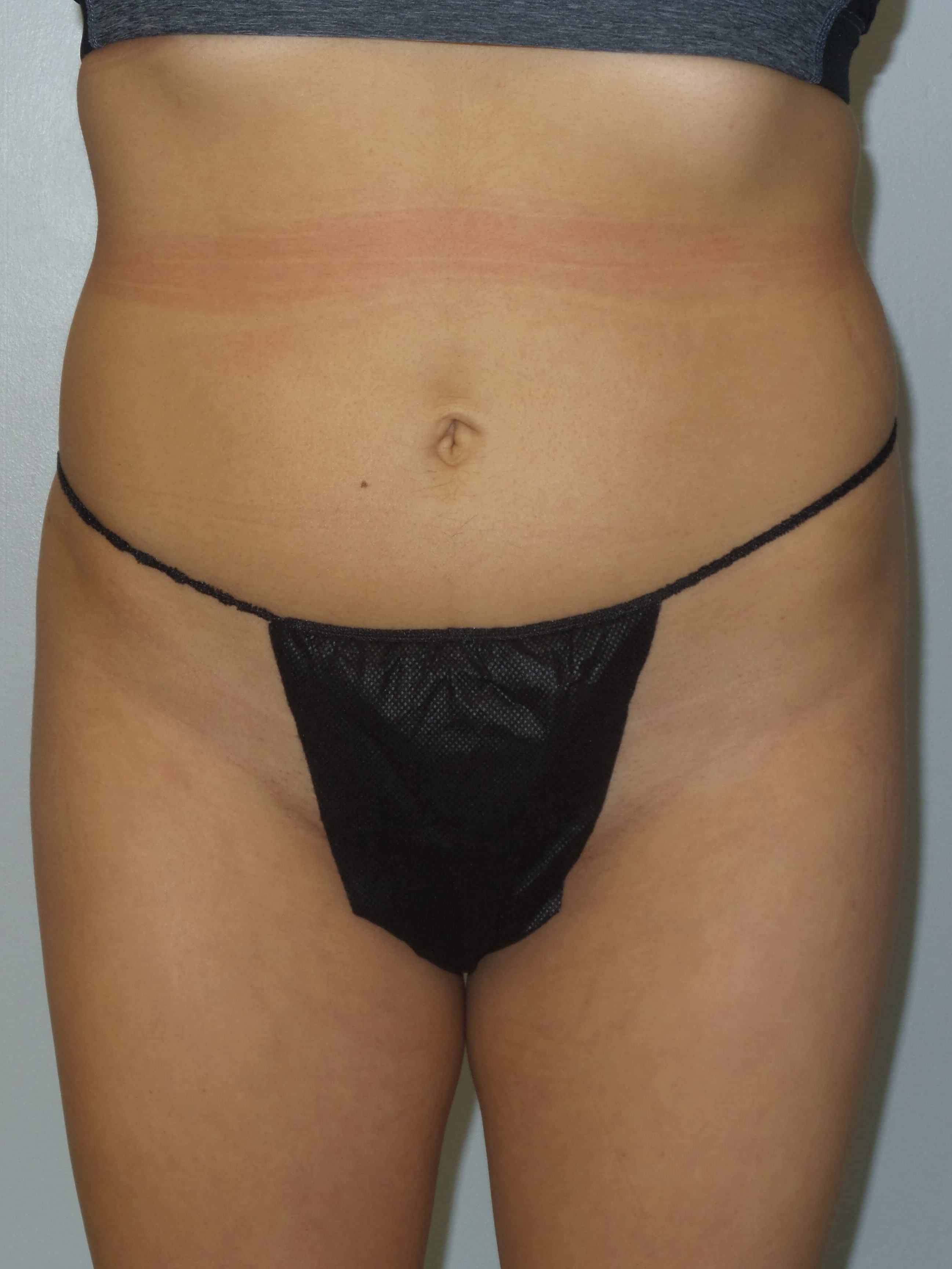 Woman has BBL Butt Lift Before