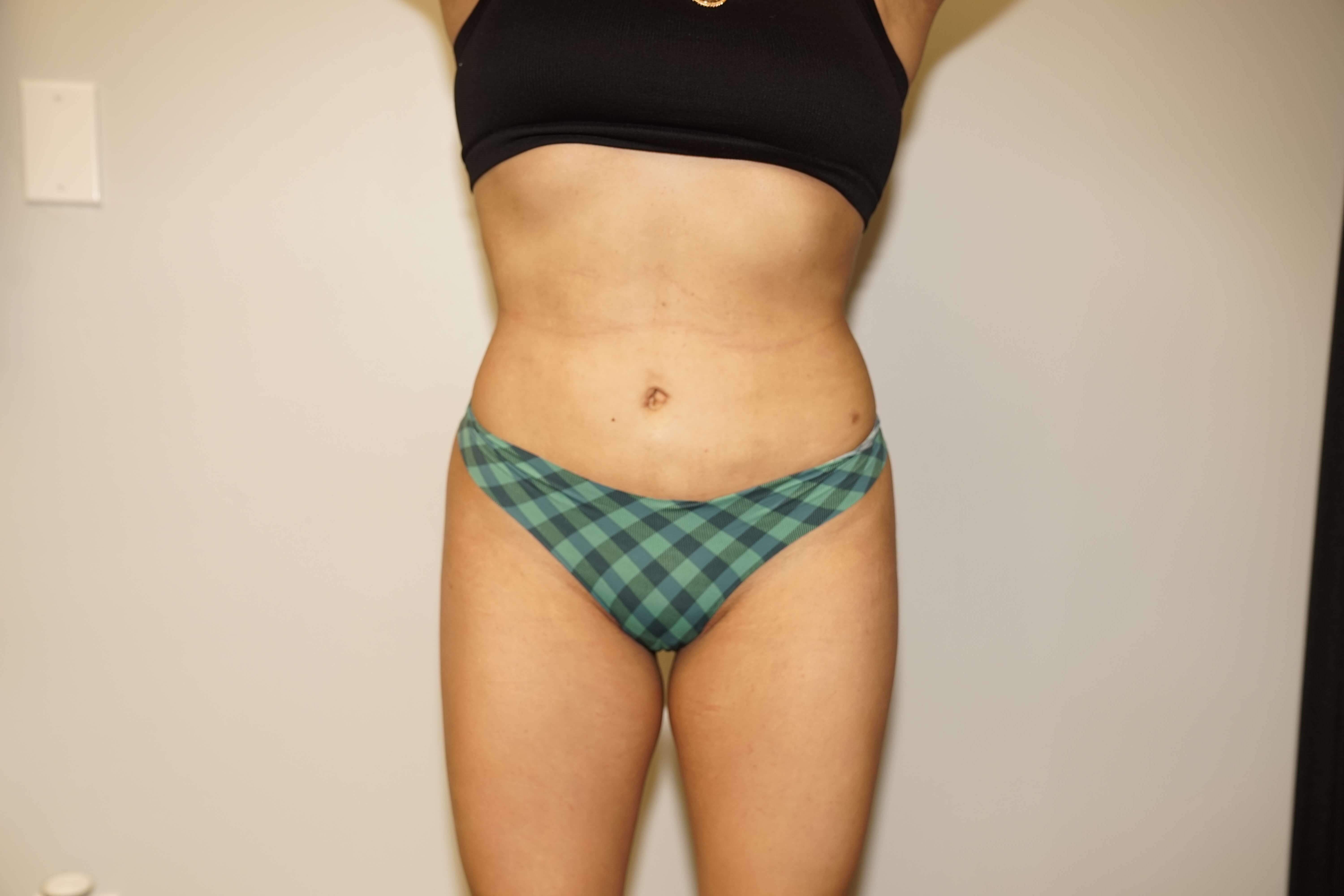 Woman has BBL Butt Lift After