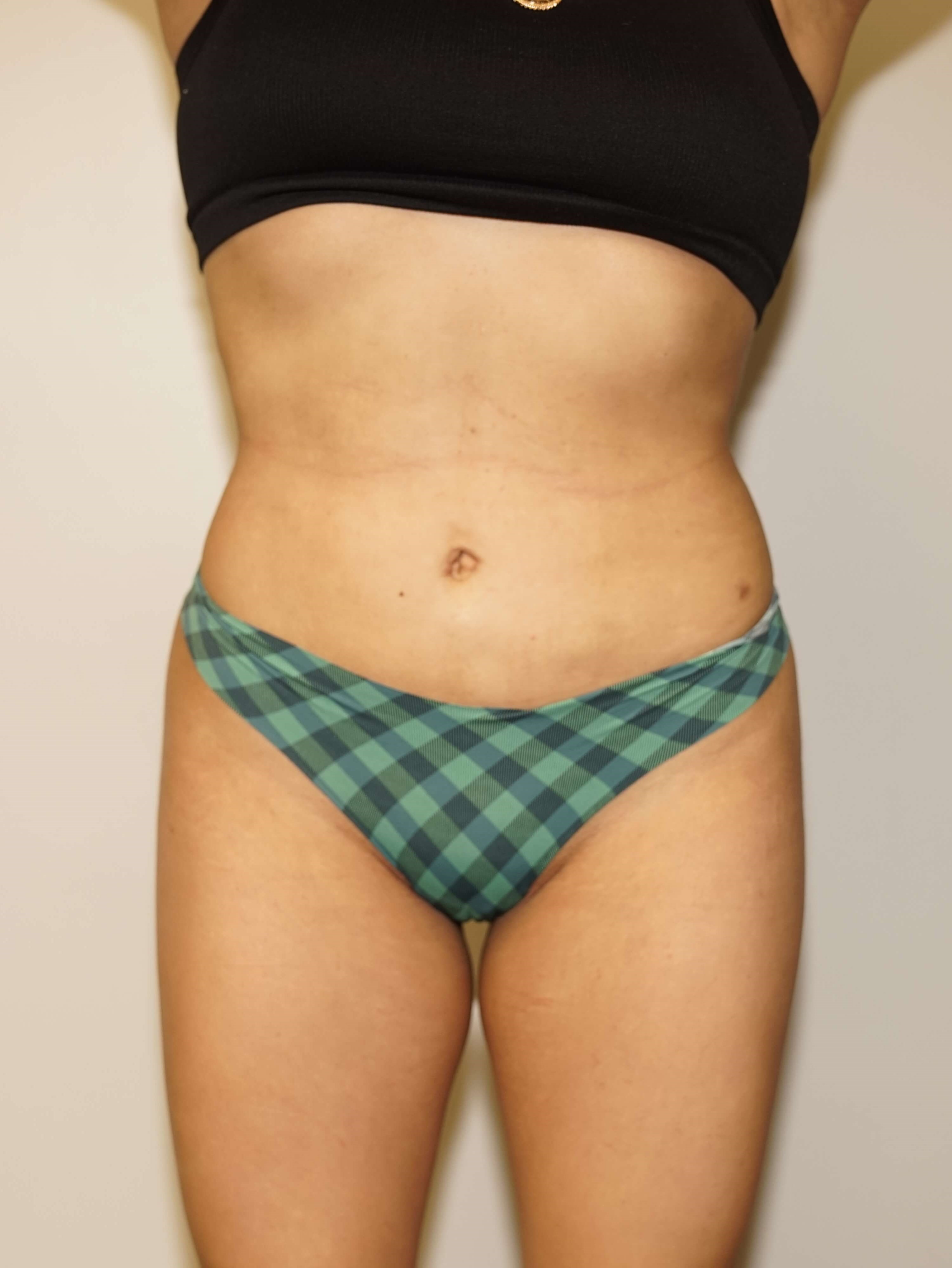 Woman has BBL Butt Lift After