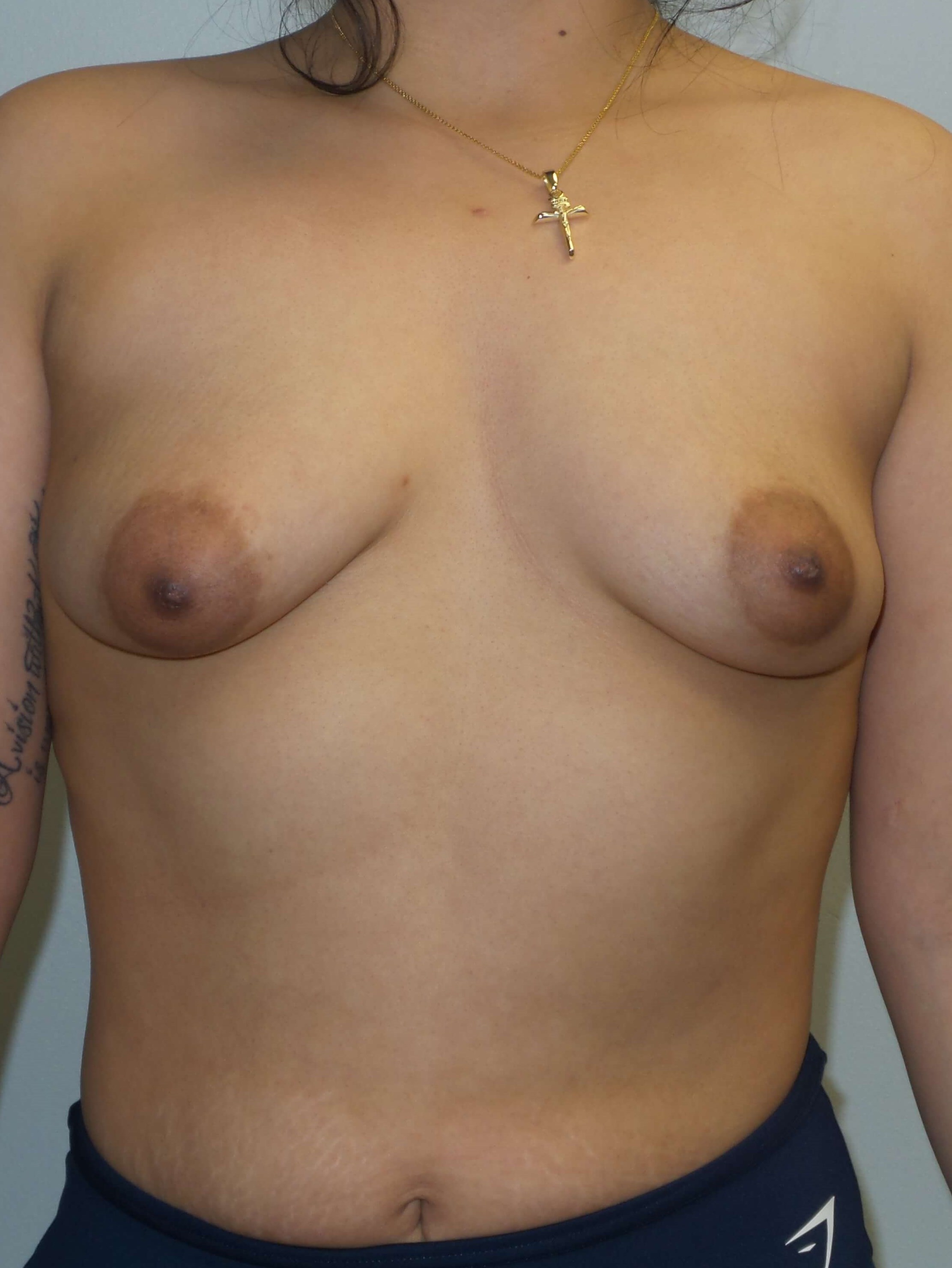 Westlake Woman Has Breast Aug Before