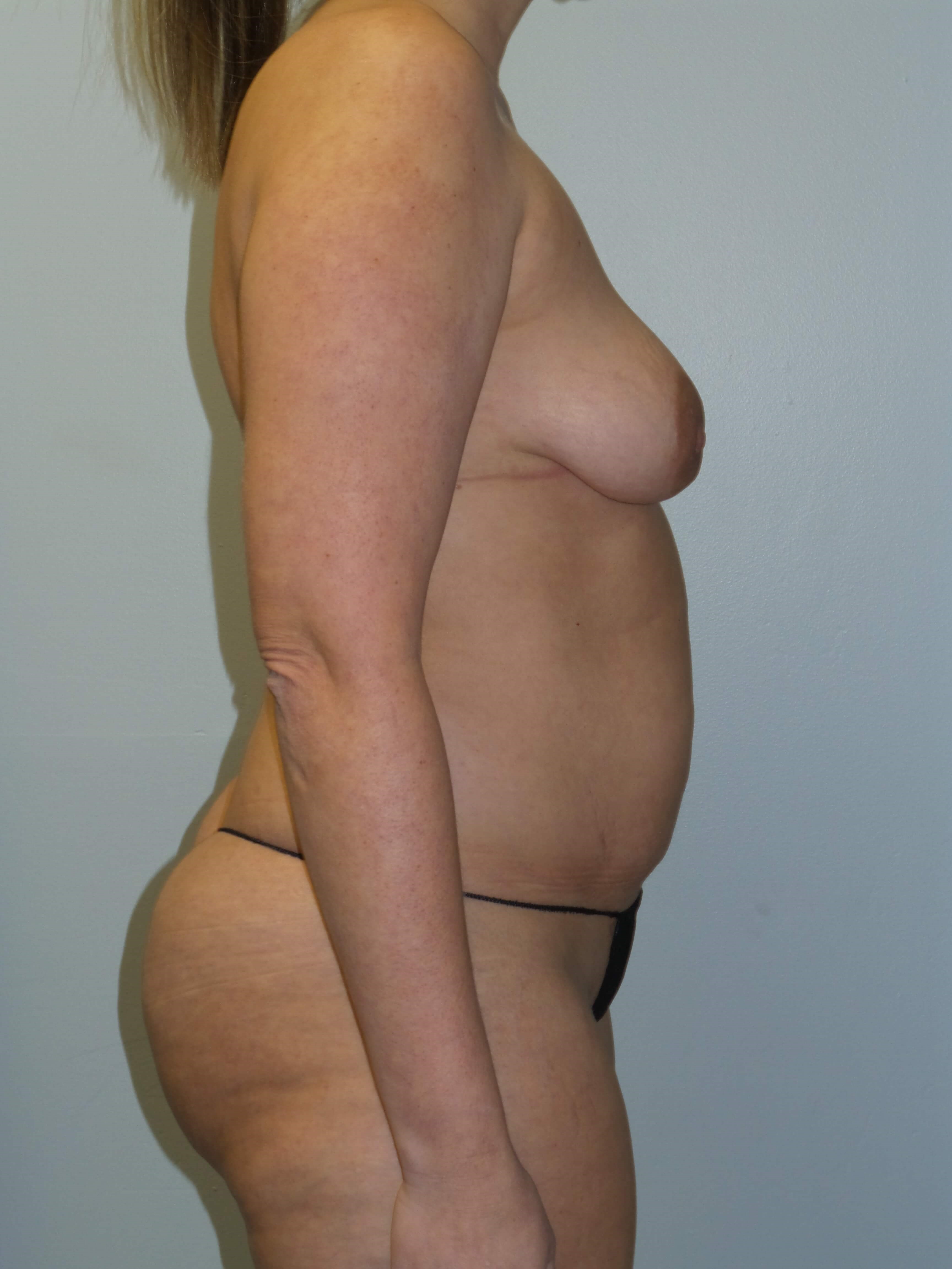 Woman has Mommy Makeover Before