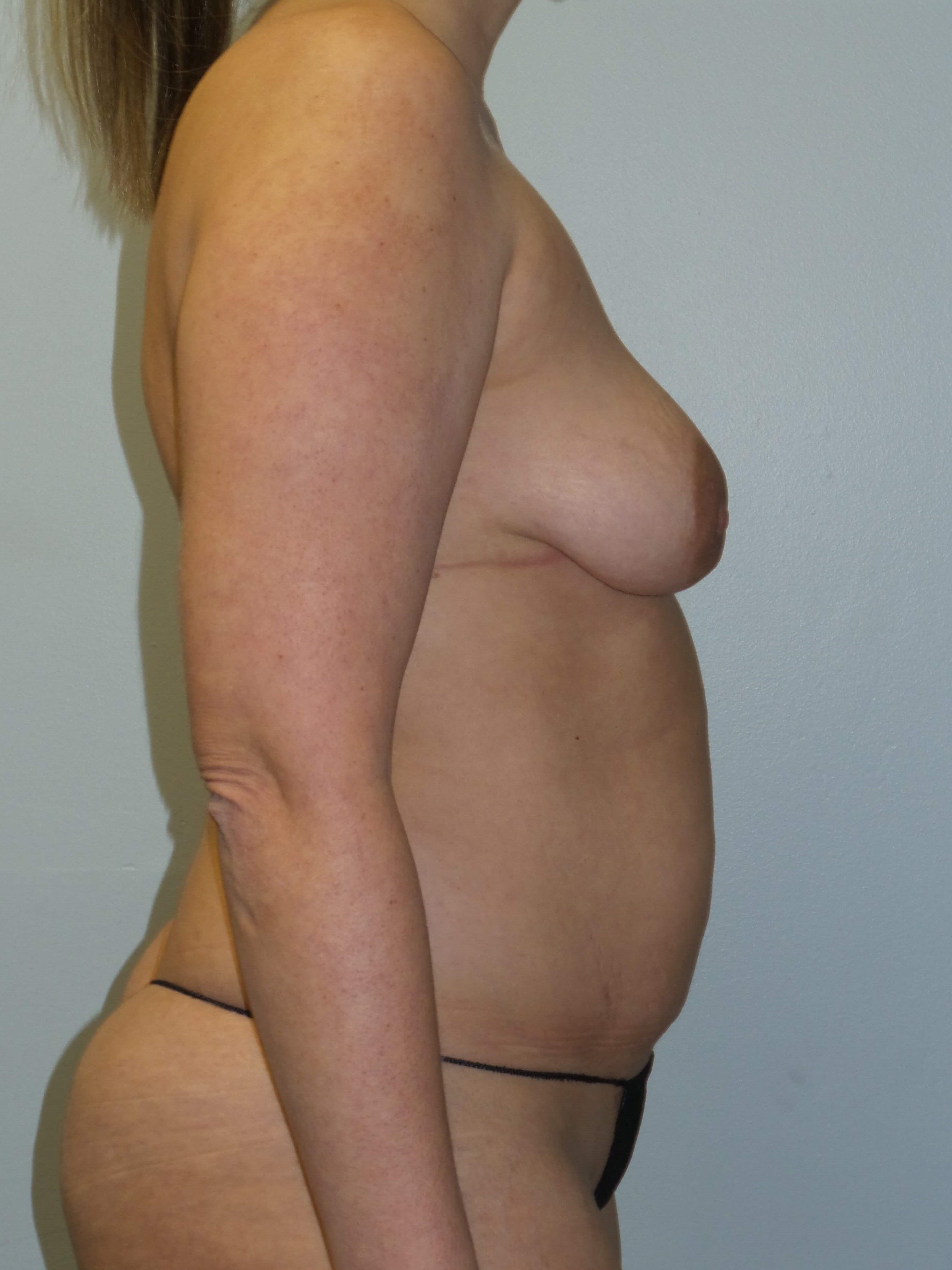 Woman has Mommy Makeover Before