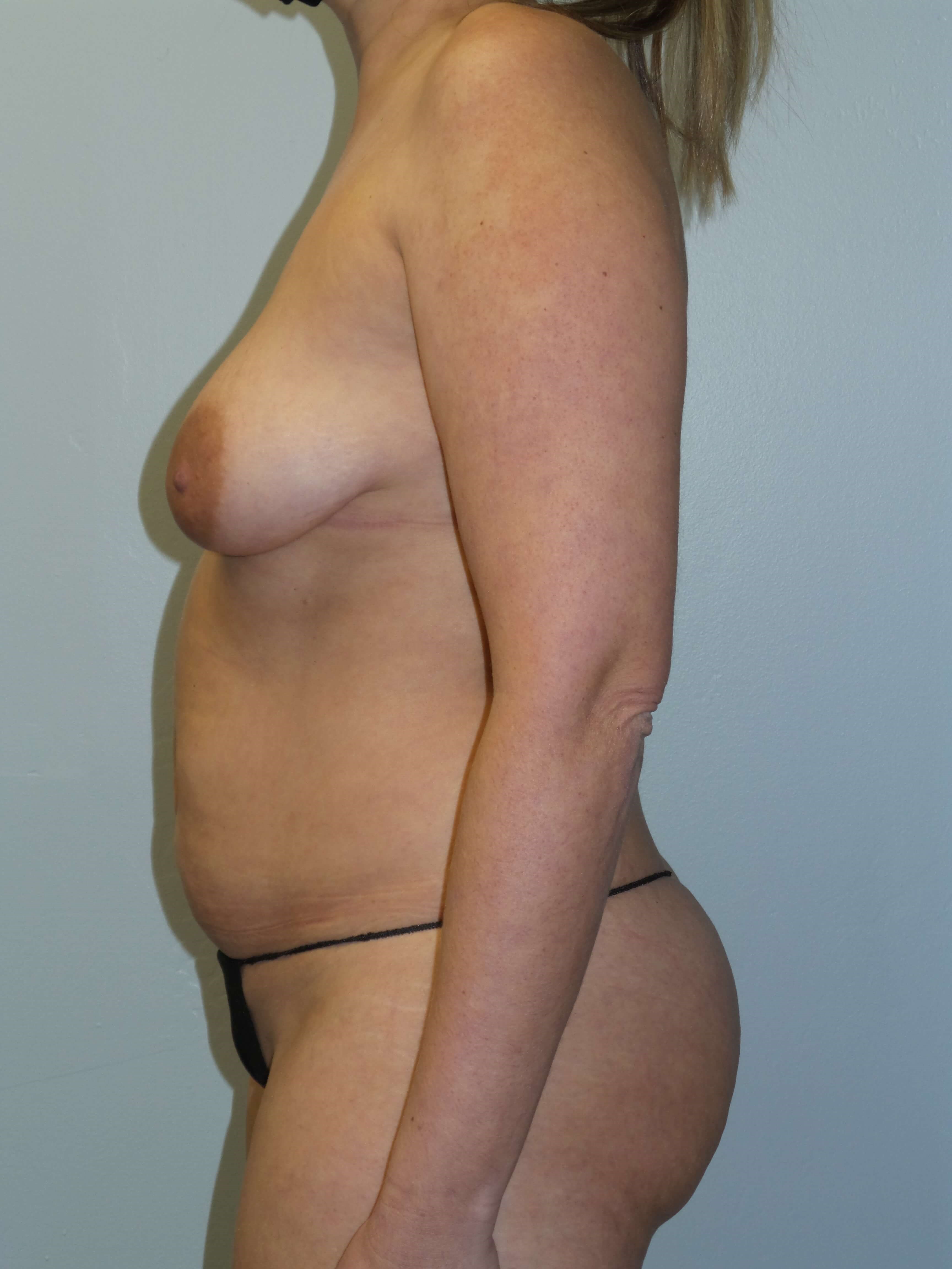Woman has Mommy Makeover Before