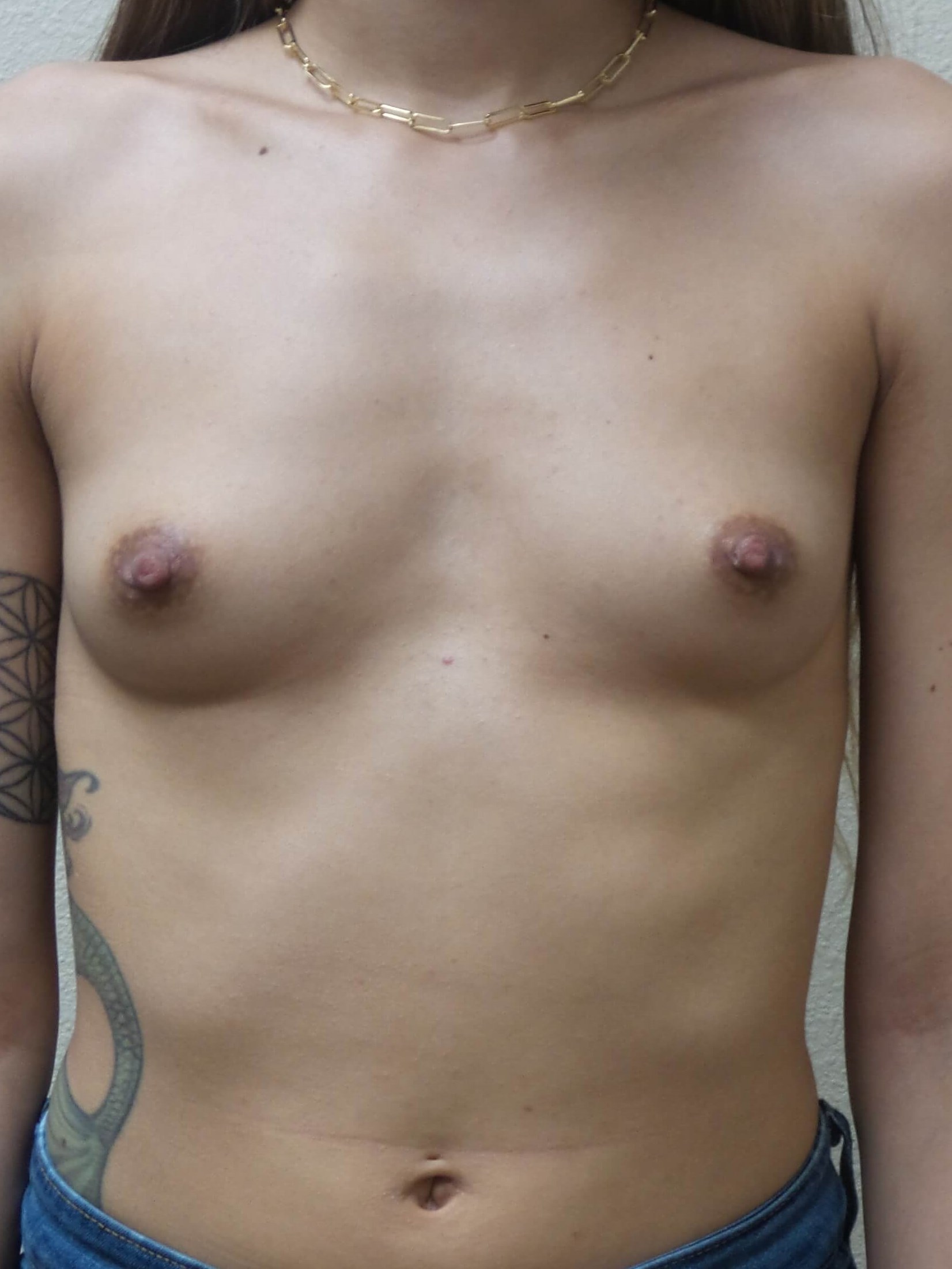 Westlake Woman Has Breast Aug Before