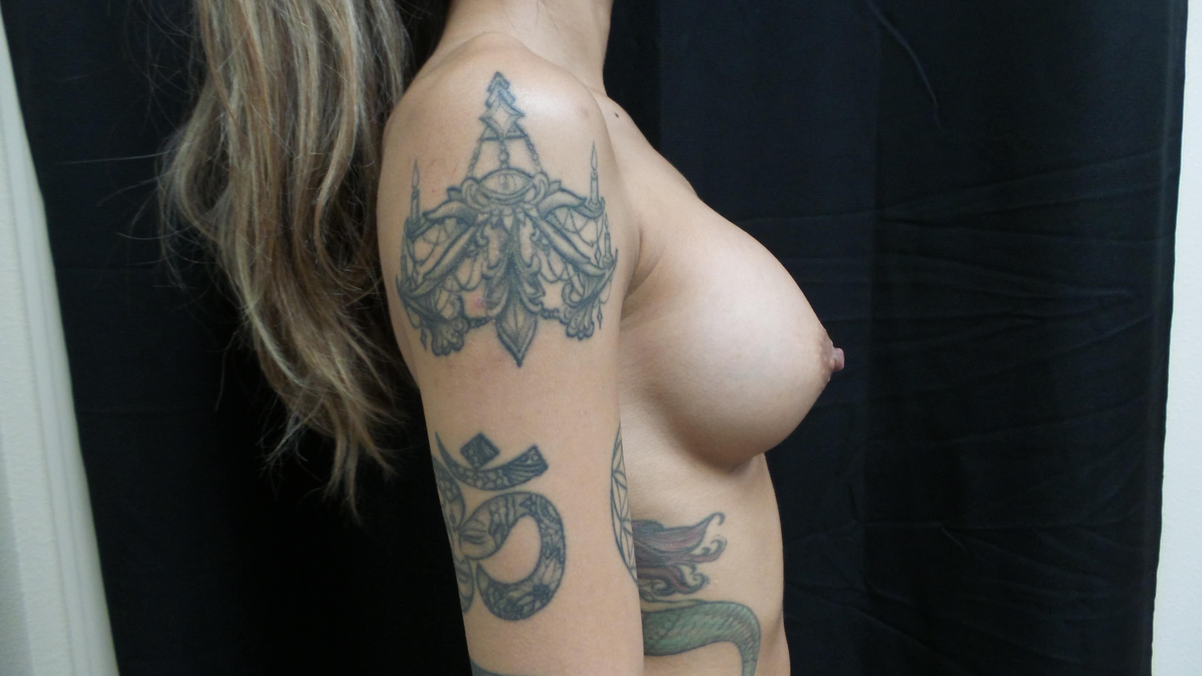 Westlake Woman Has Breast Aug After