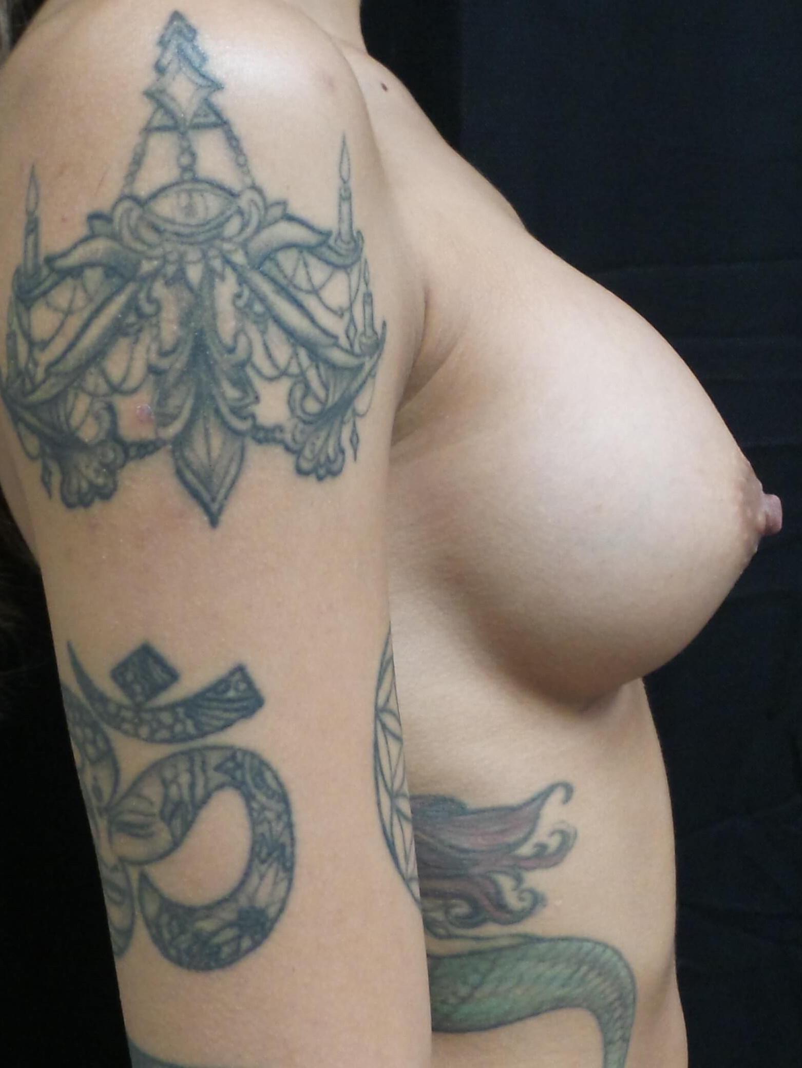 Westlake Woman Has Breast Aug After