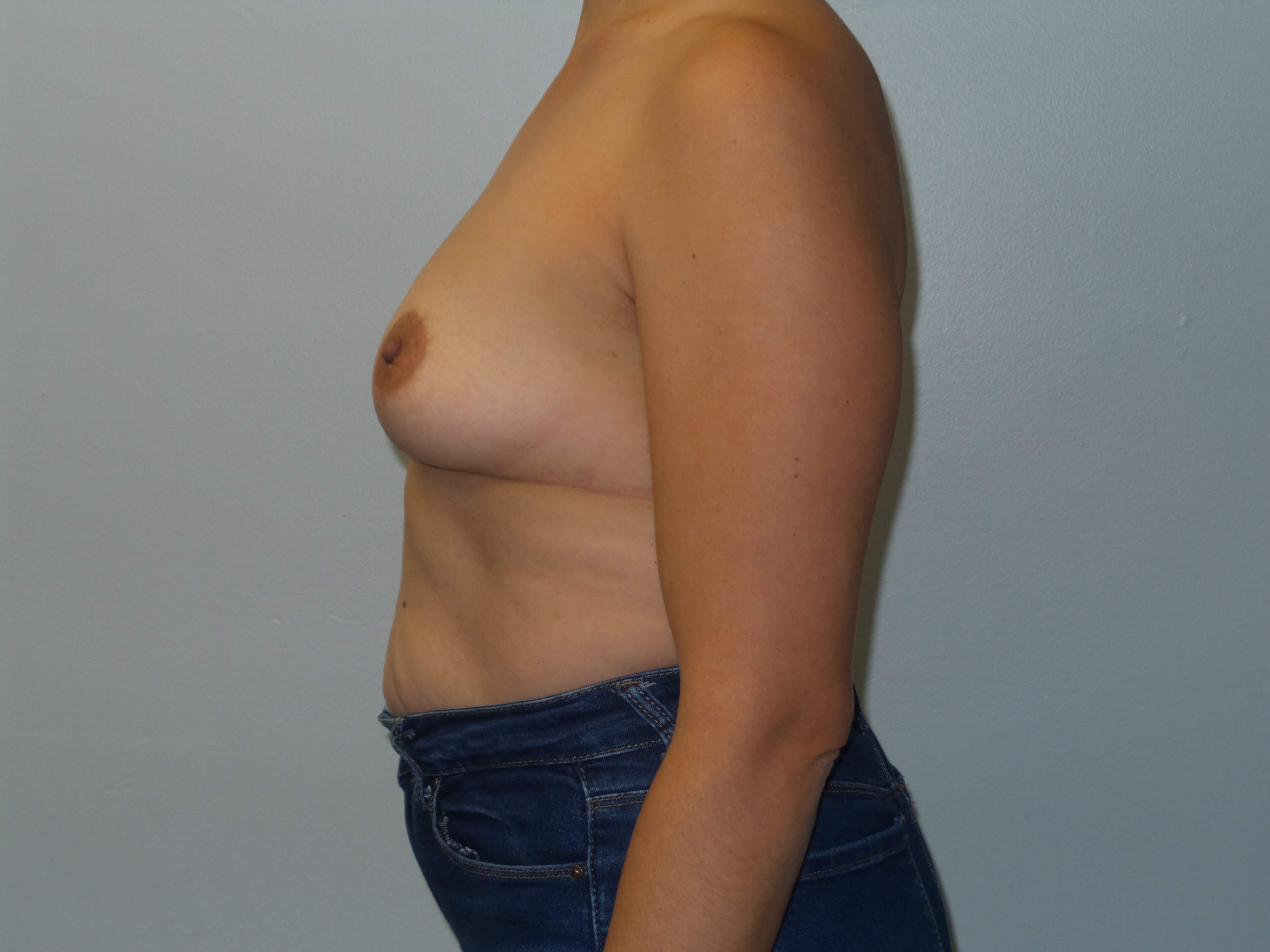Westlake Woman Has Breast Aug Before