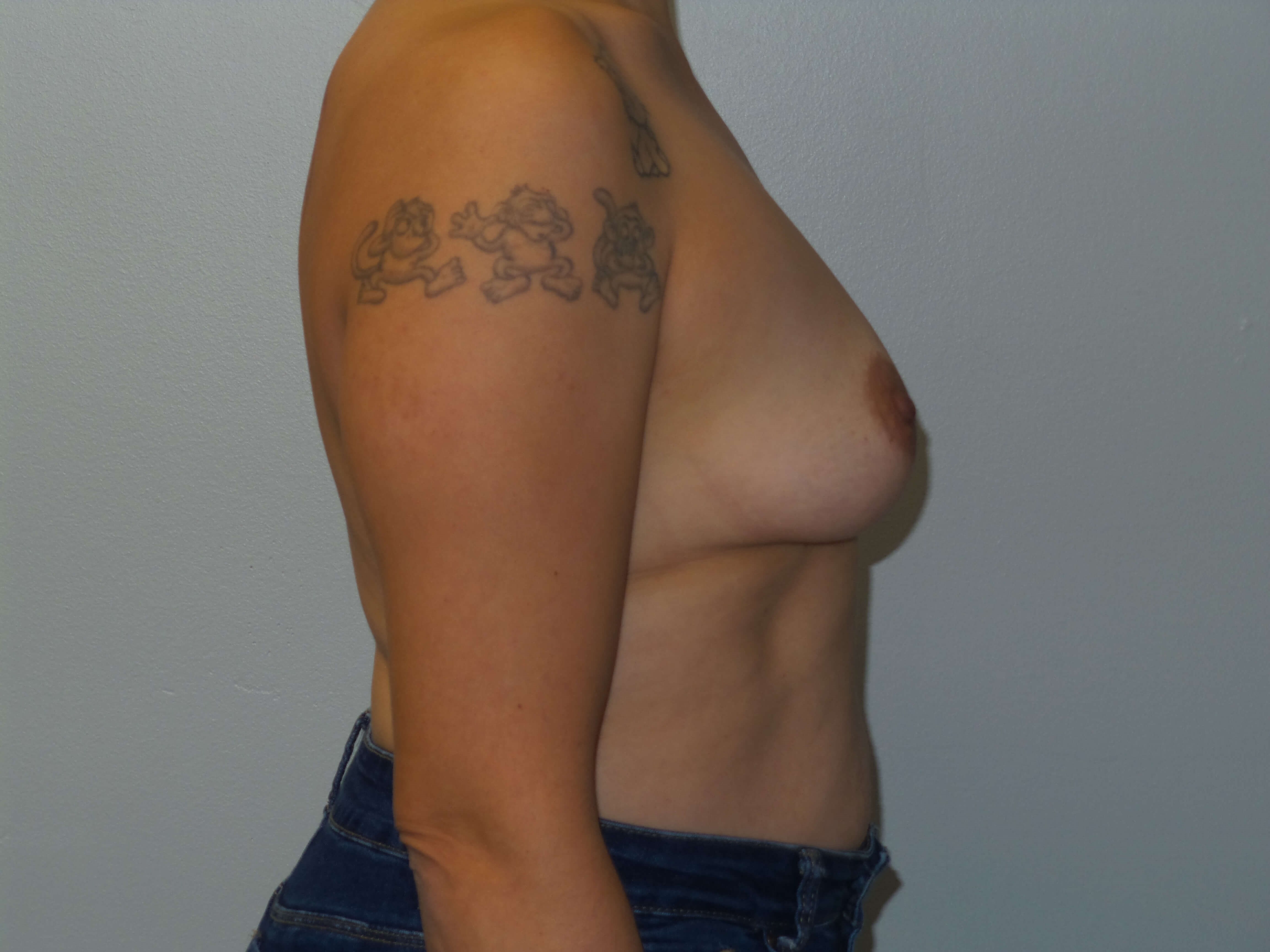 Westlake Woman Has Breast Aug Before