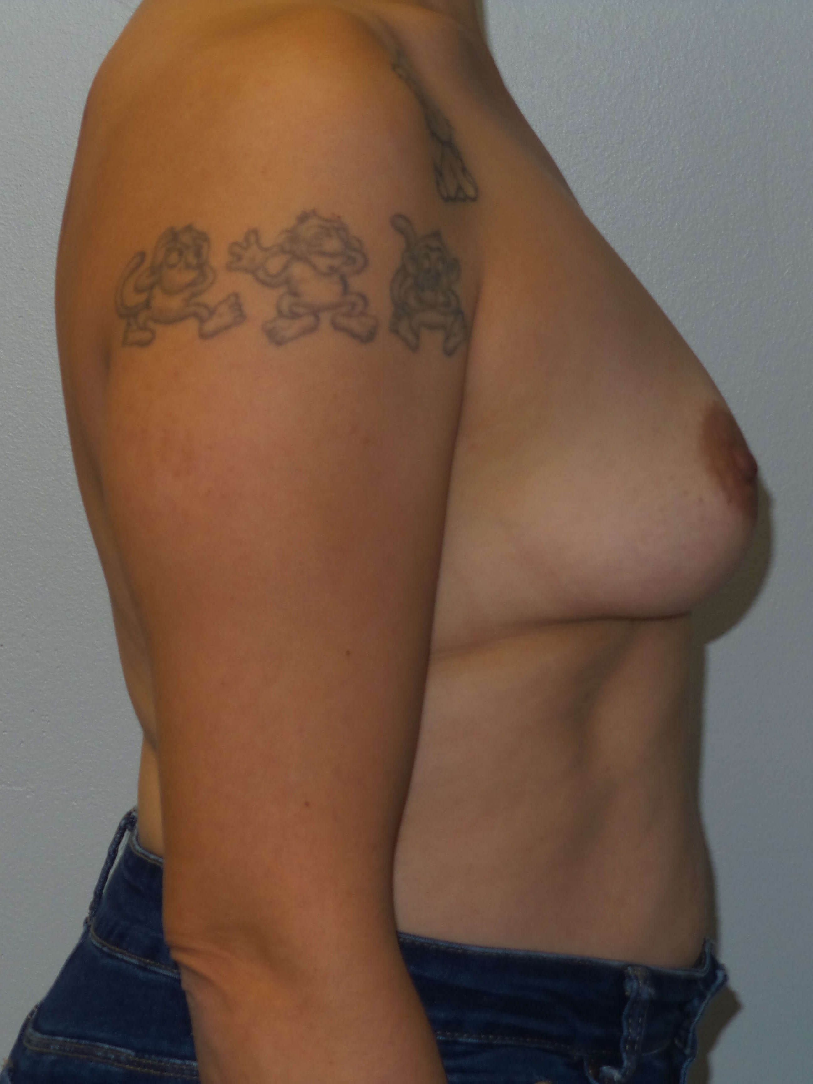 Westlake Woman Has Breast Aug Before