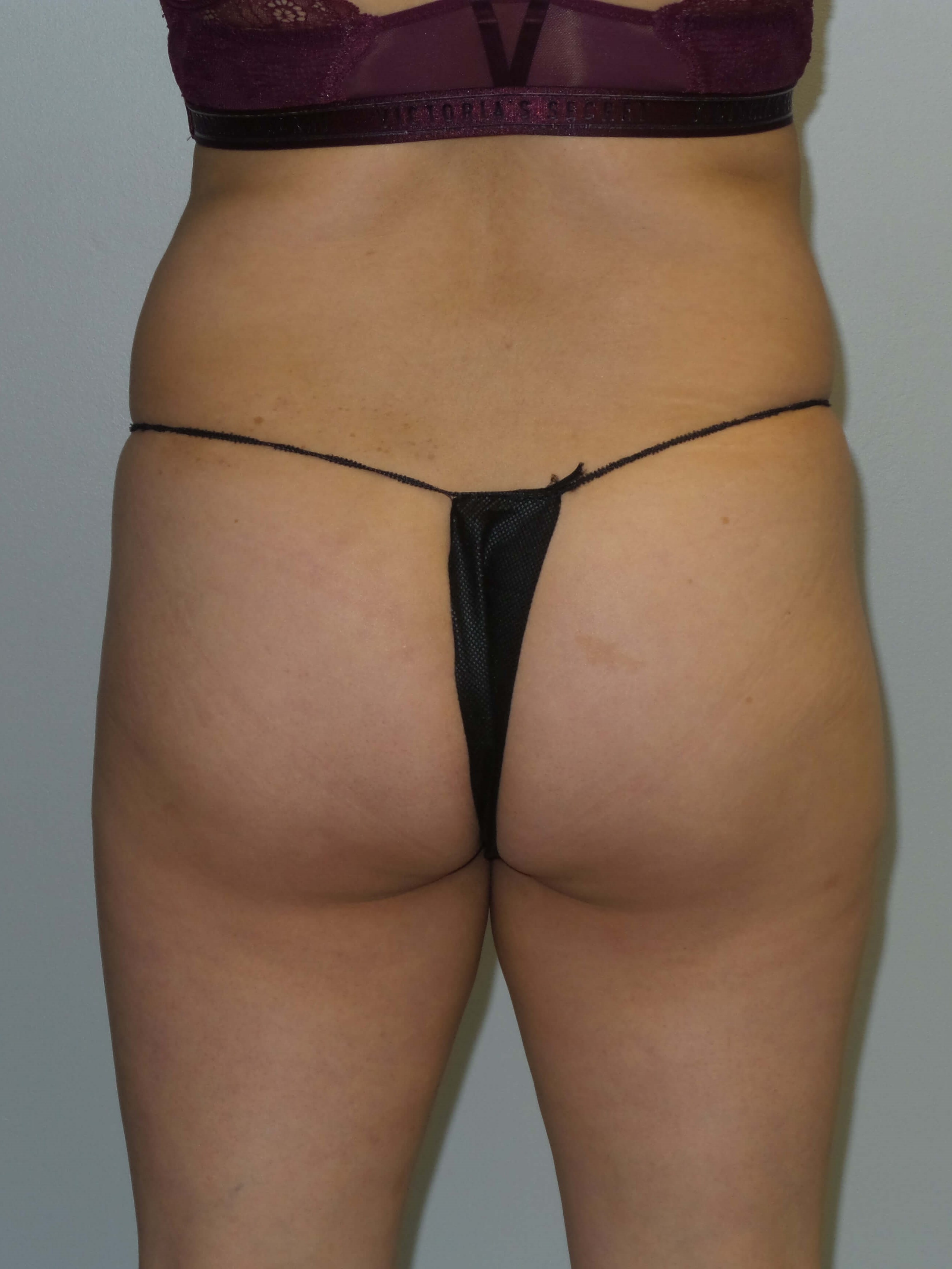 Woman has BBL Butt Lift Before
