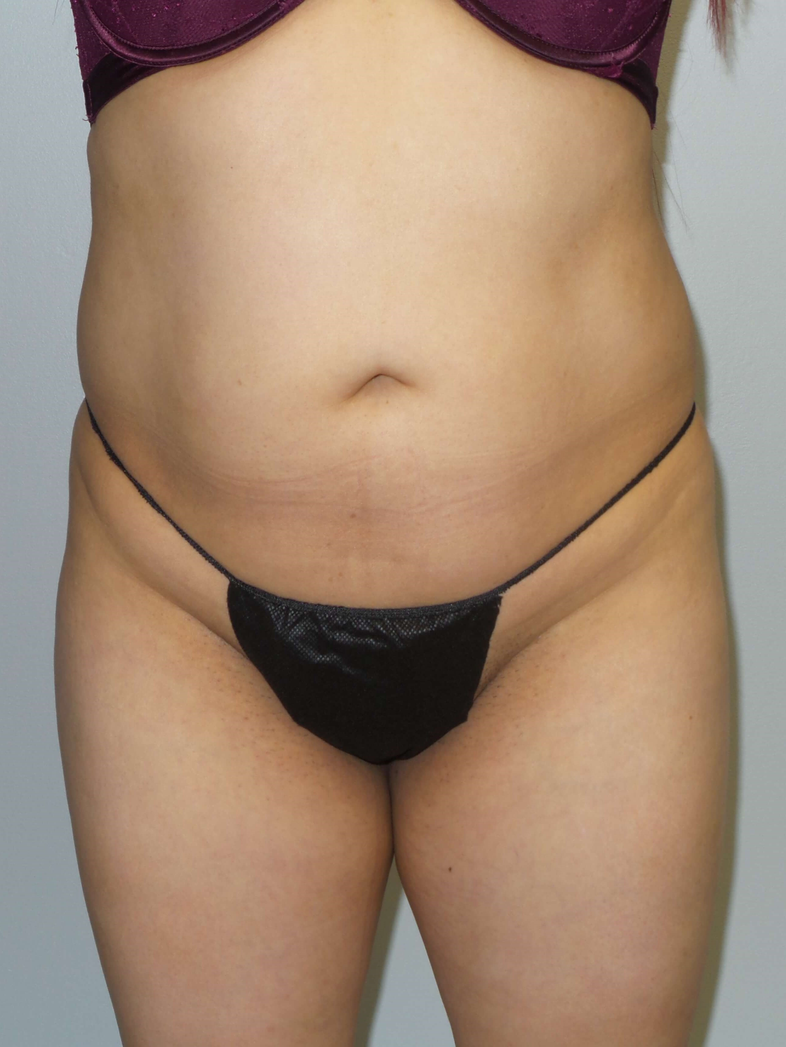 Woman has BBL Butt Lift Before