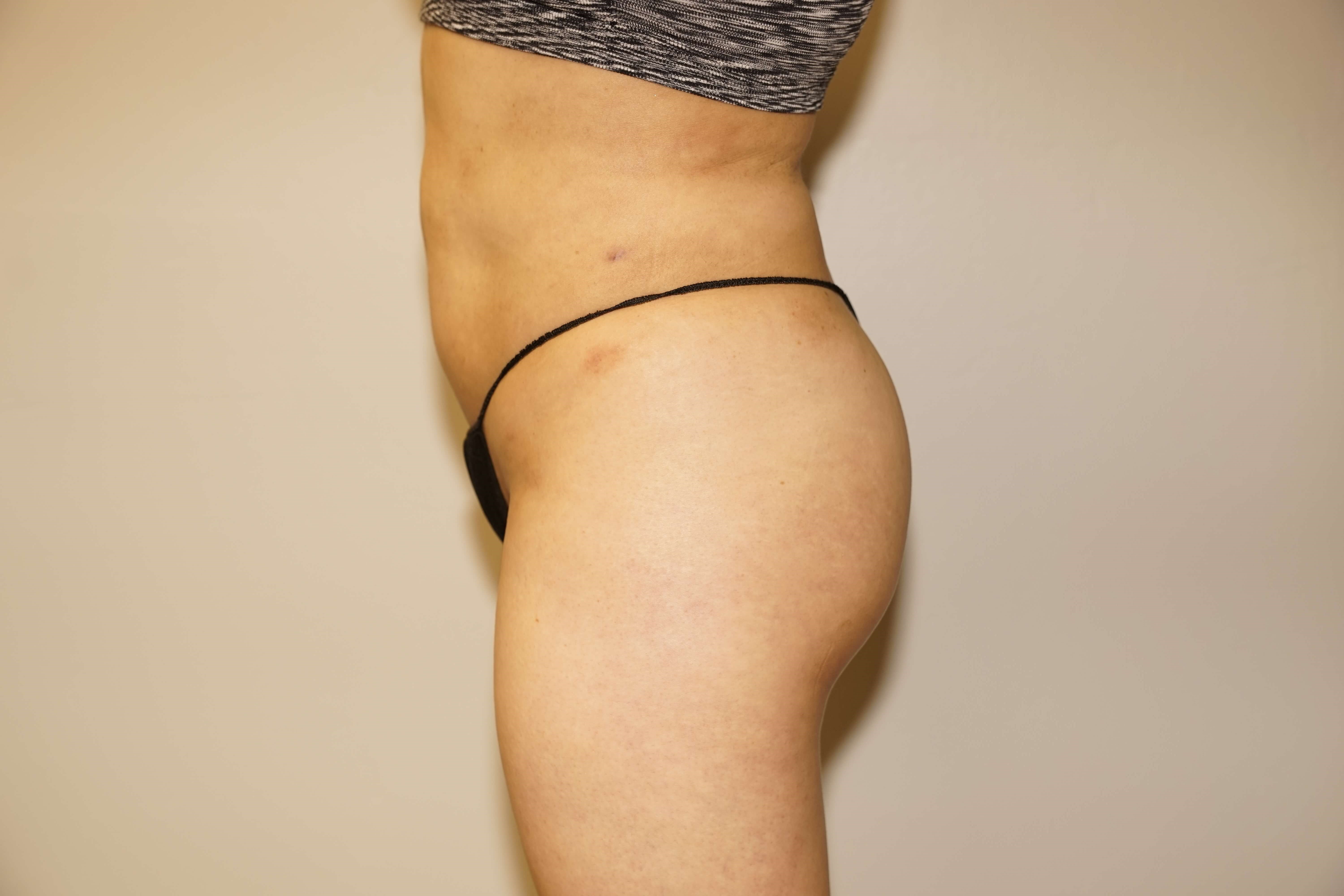 Woman has BBL Butt Lift After