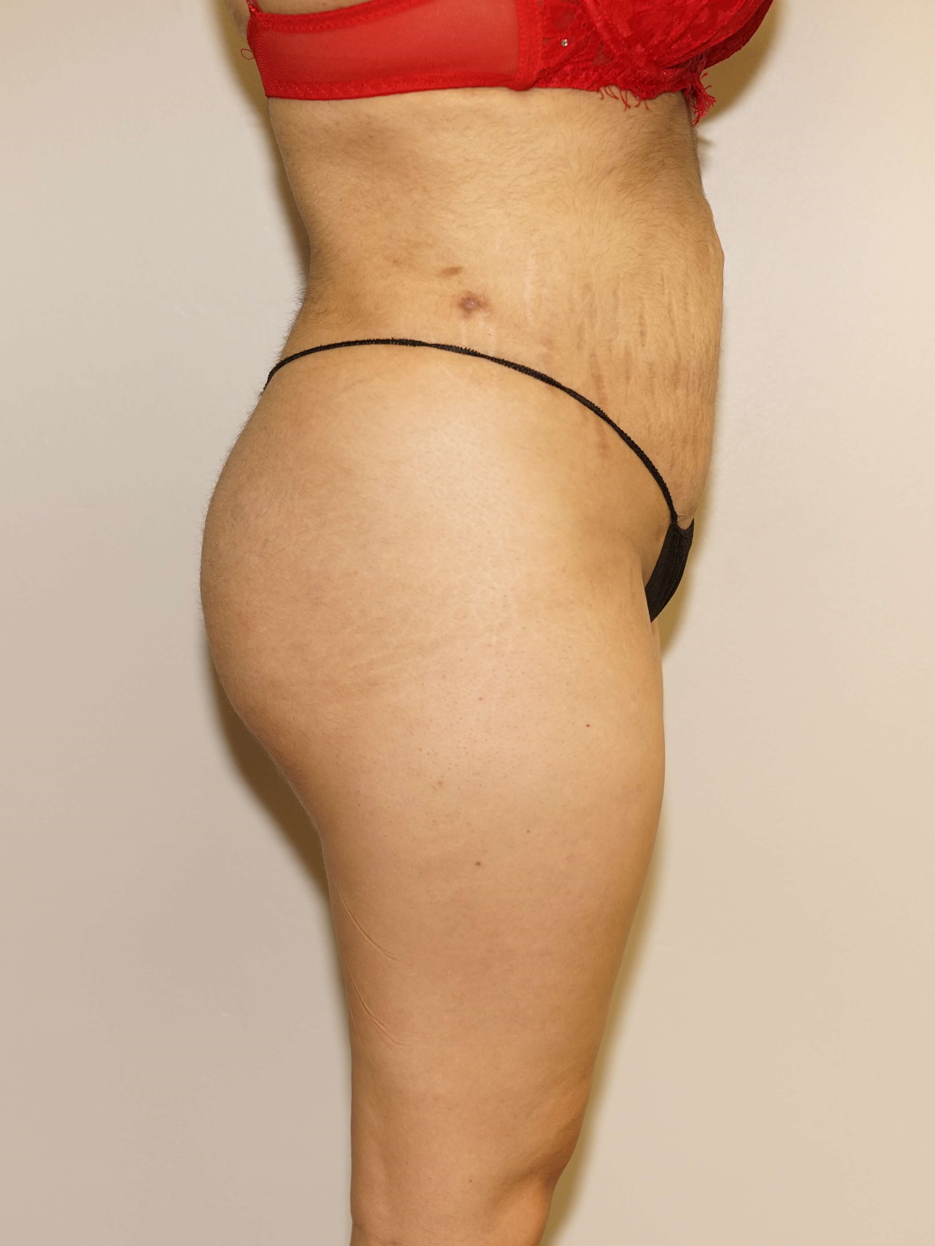 Woman has BBL Butt Lift After