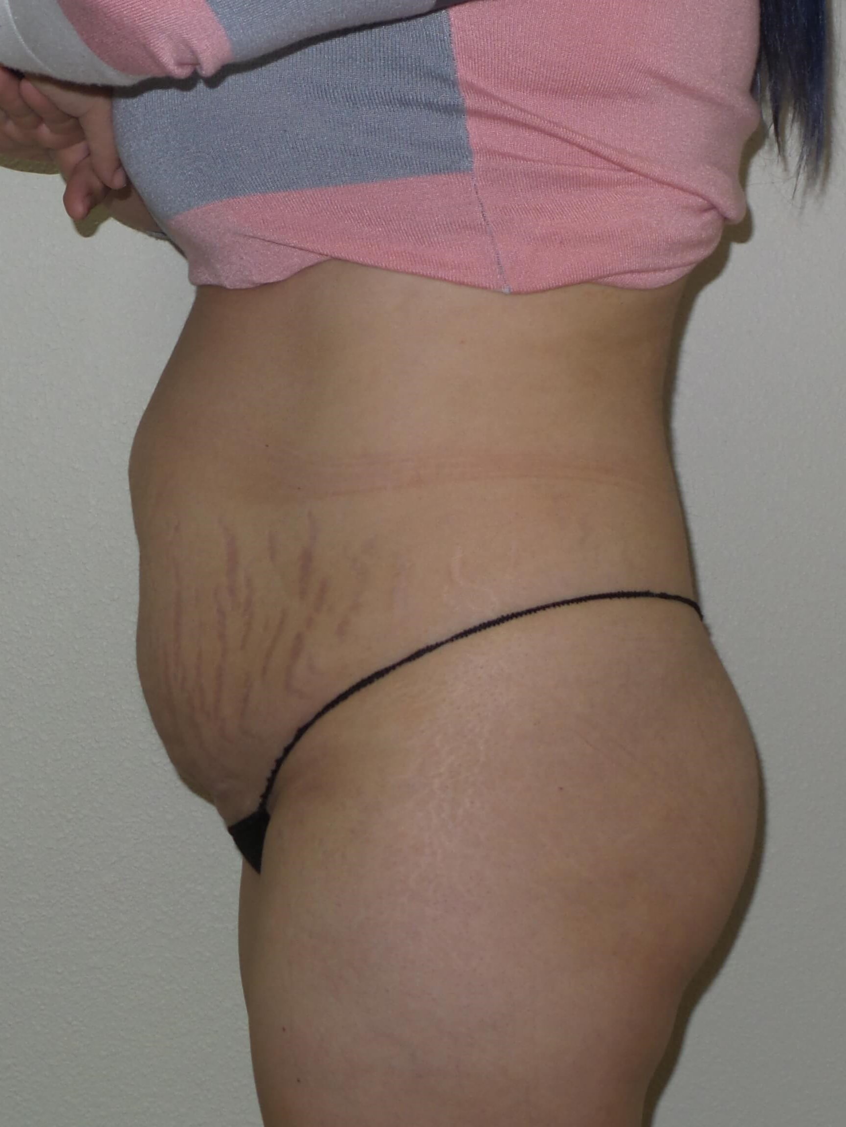 Woman has BBL Butt Lift Before
