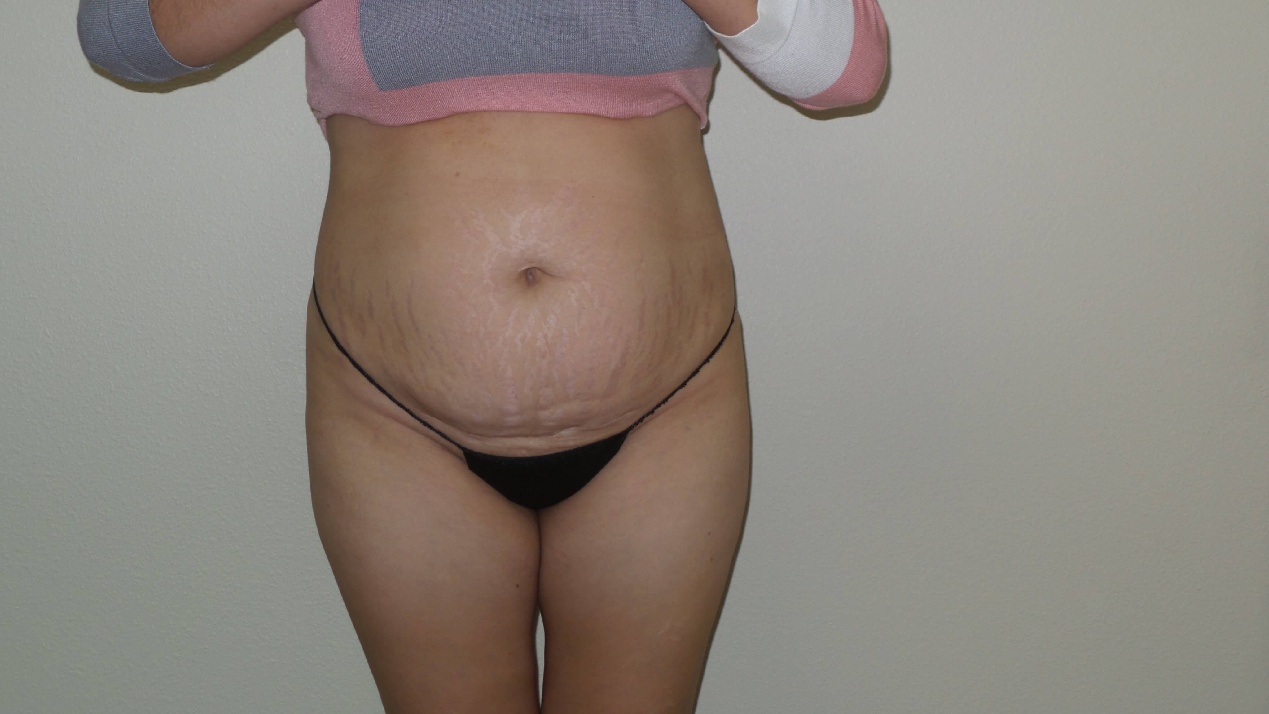 Woman has BBL Butt Lift Before