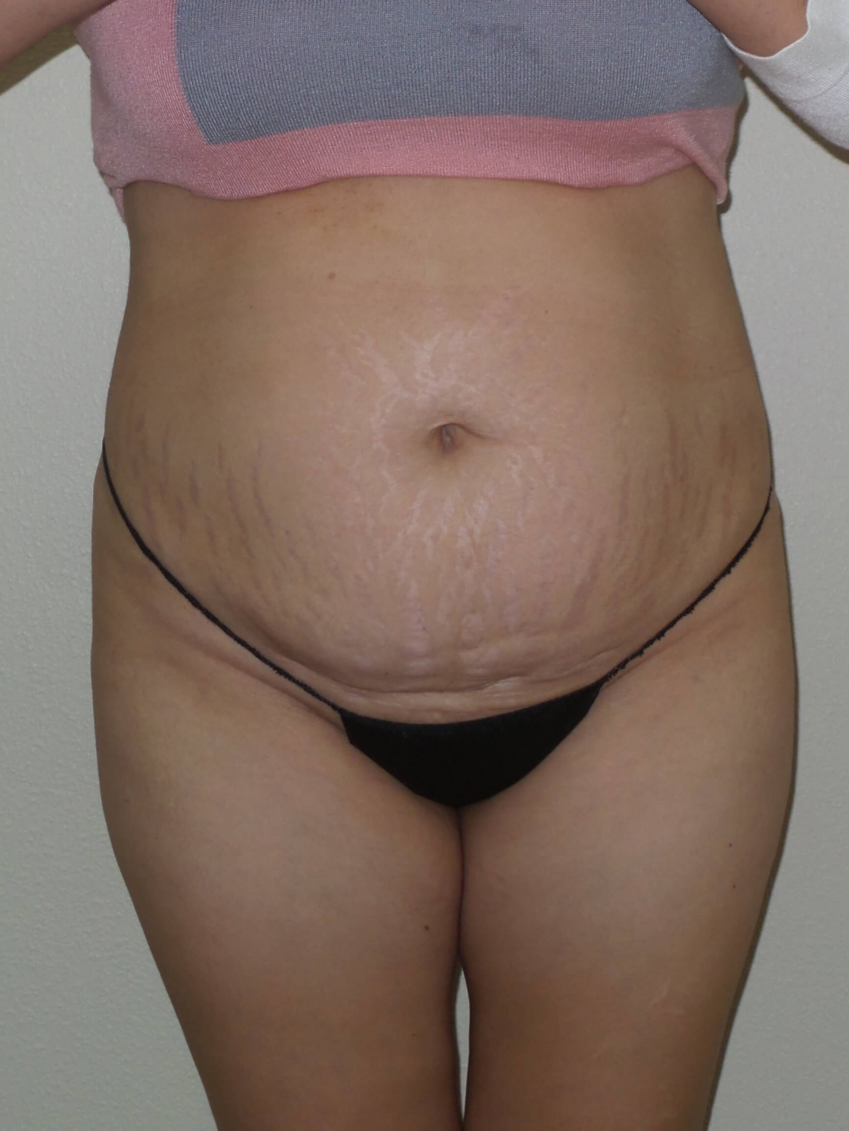 Woman has BBL Butt Lift Before