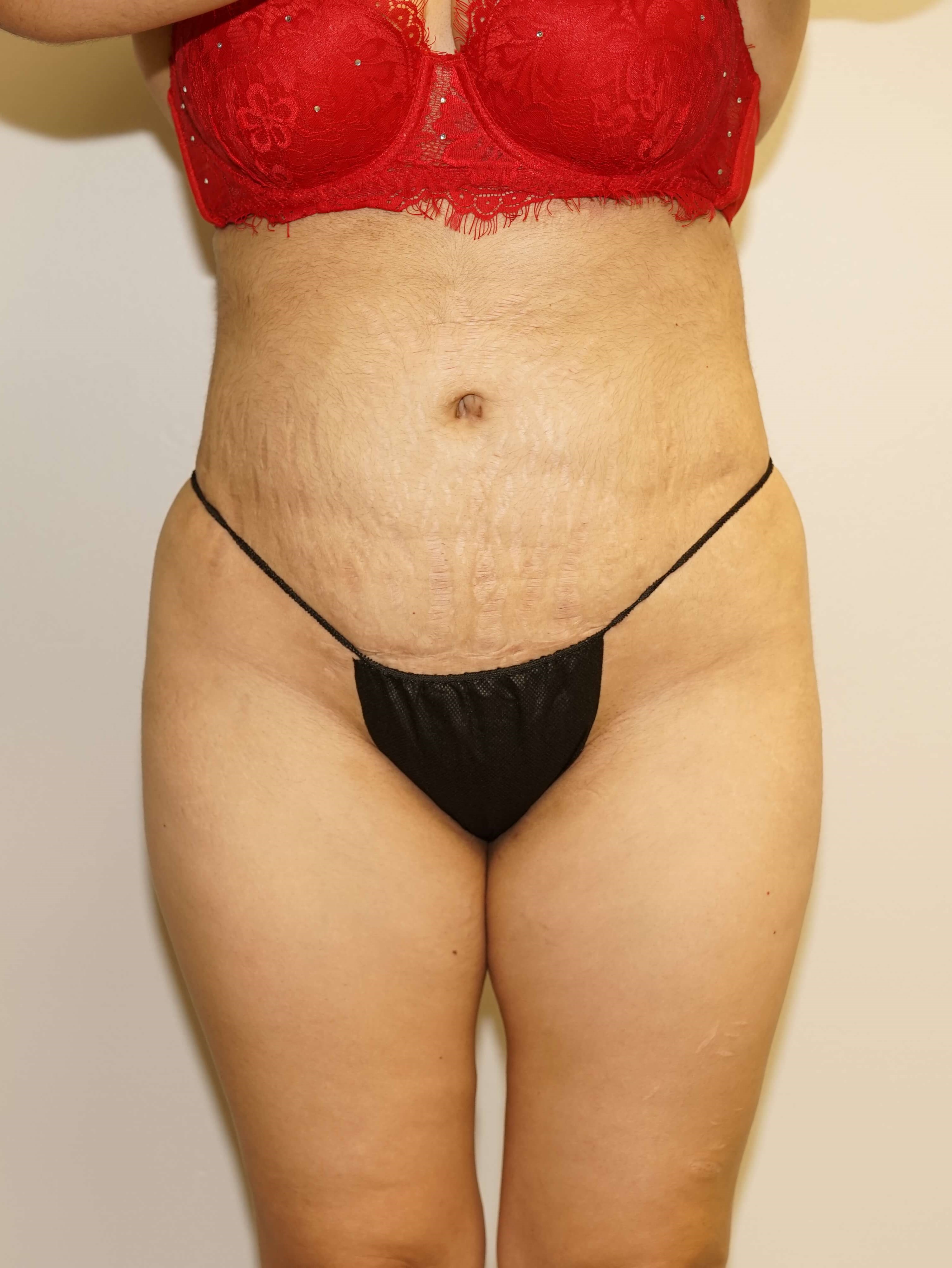 Woman has BBL Butt Lift After
