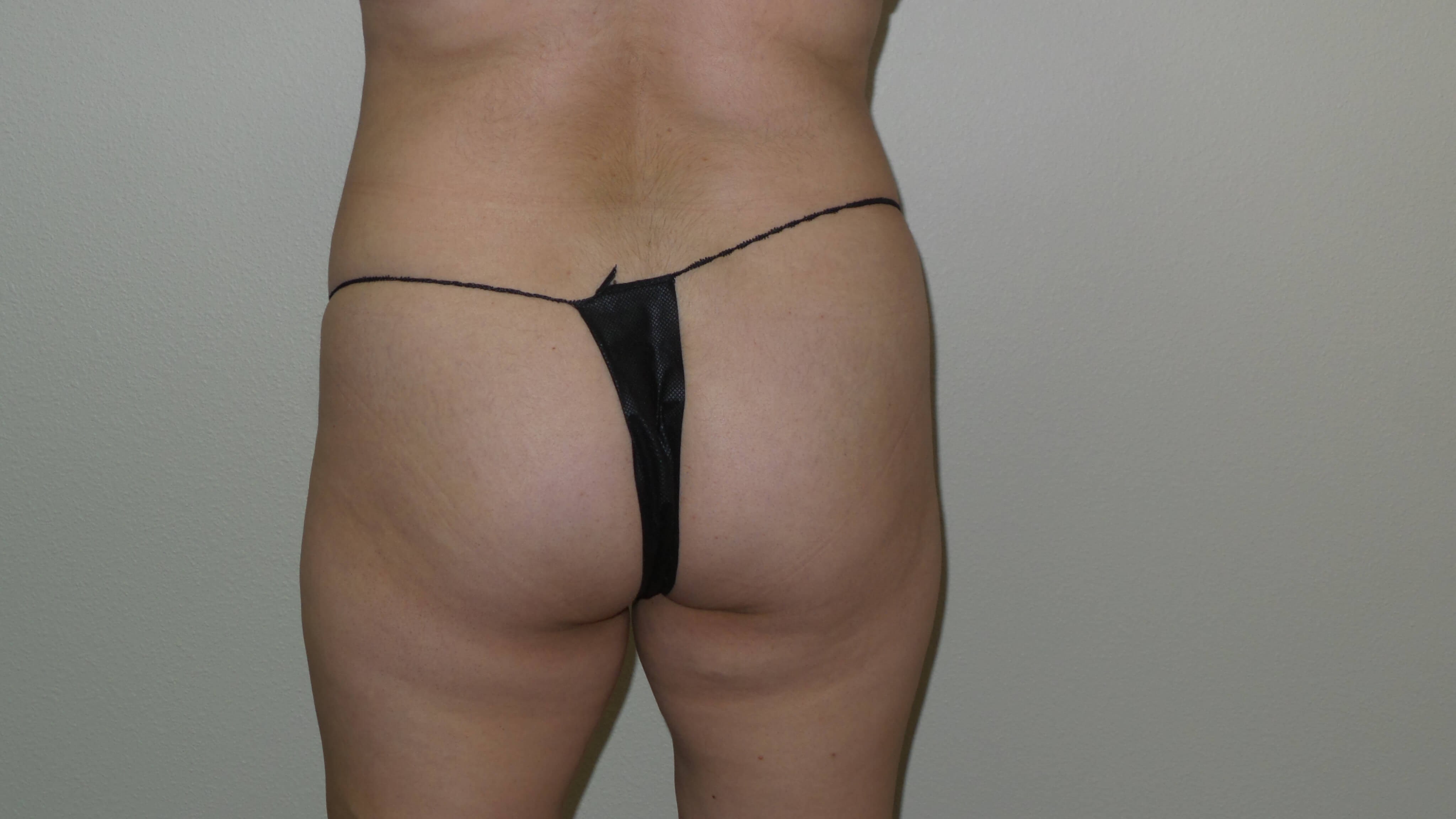 Woman has BBL Butt Lift Before