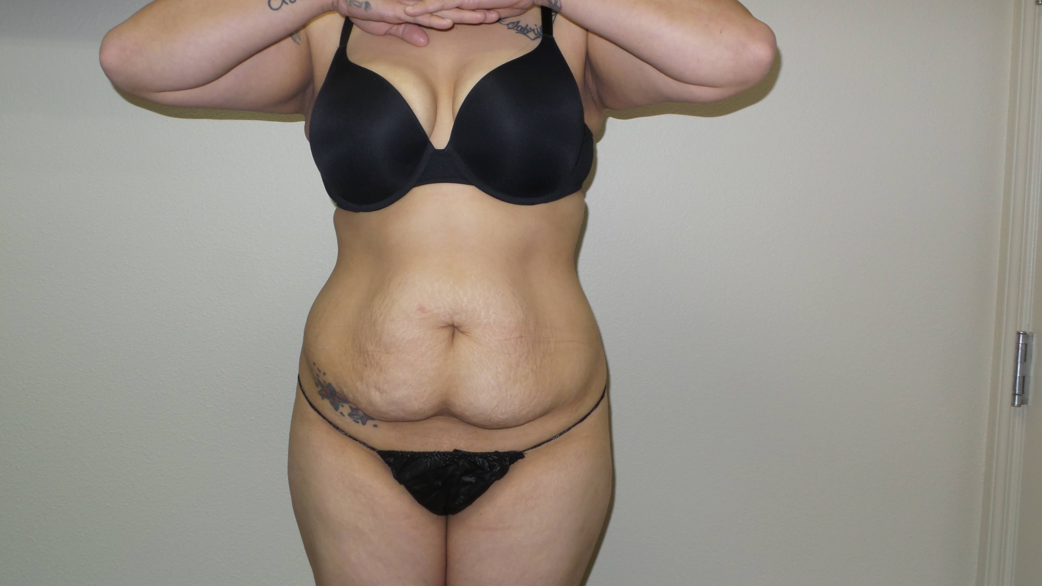 Woman Has Tummy Tuck Lipo Before