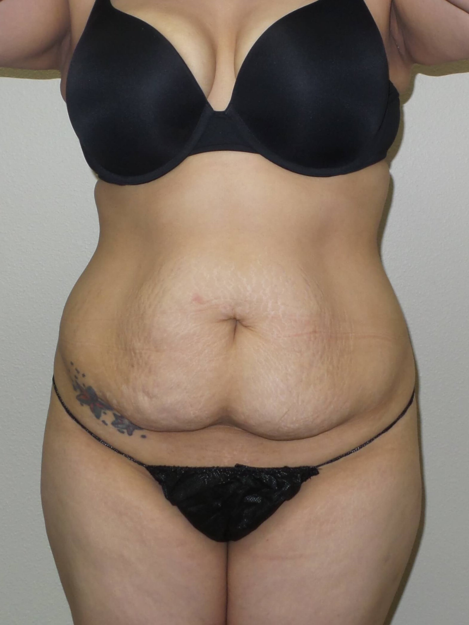Woman Has Tummy Tuck Lipo Before