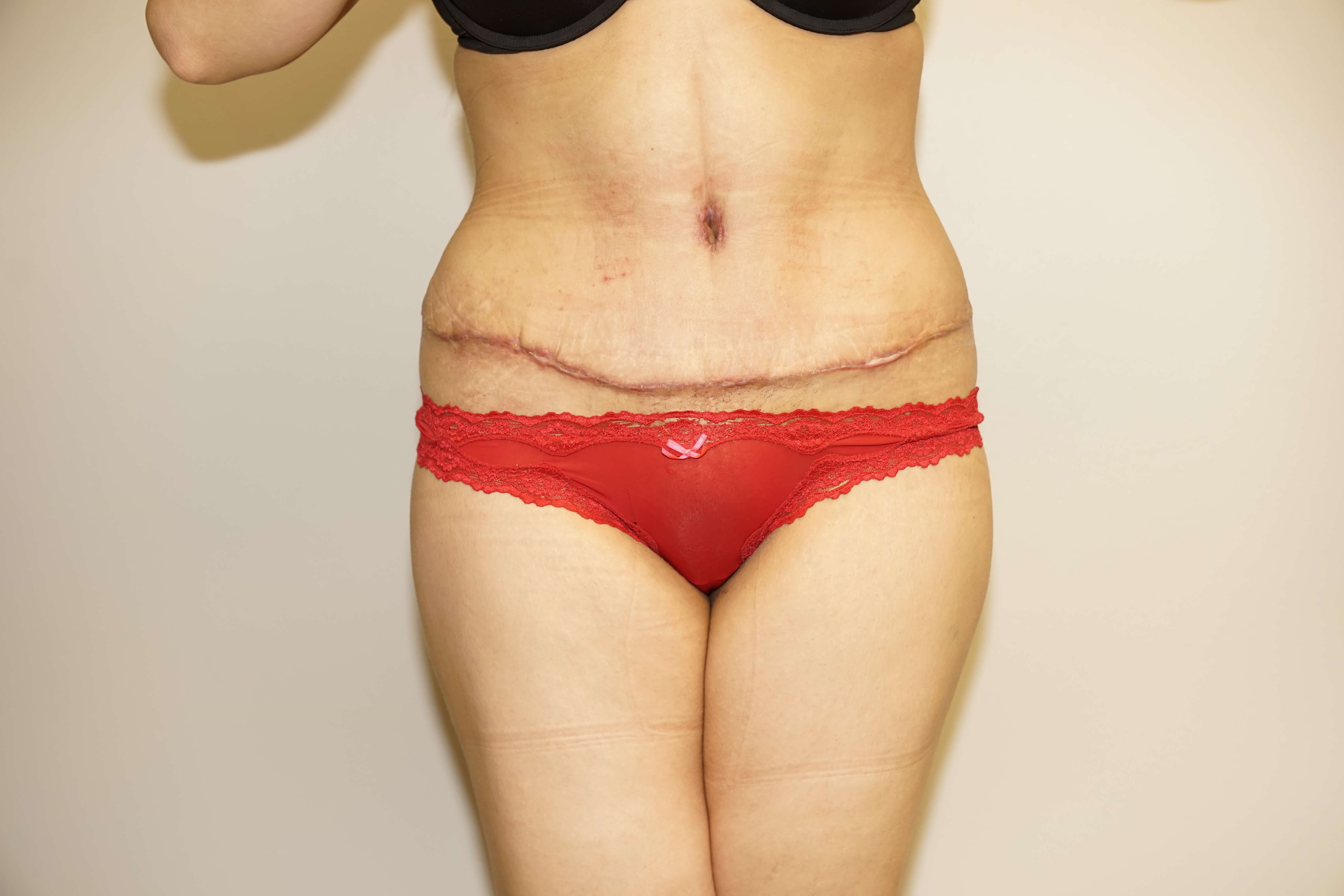 Woman Has Tummy Tuck Lipo After