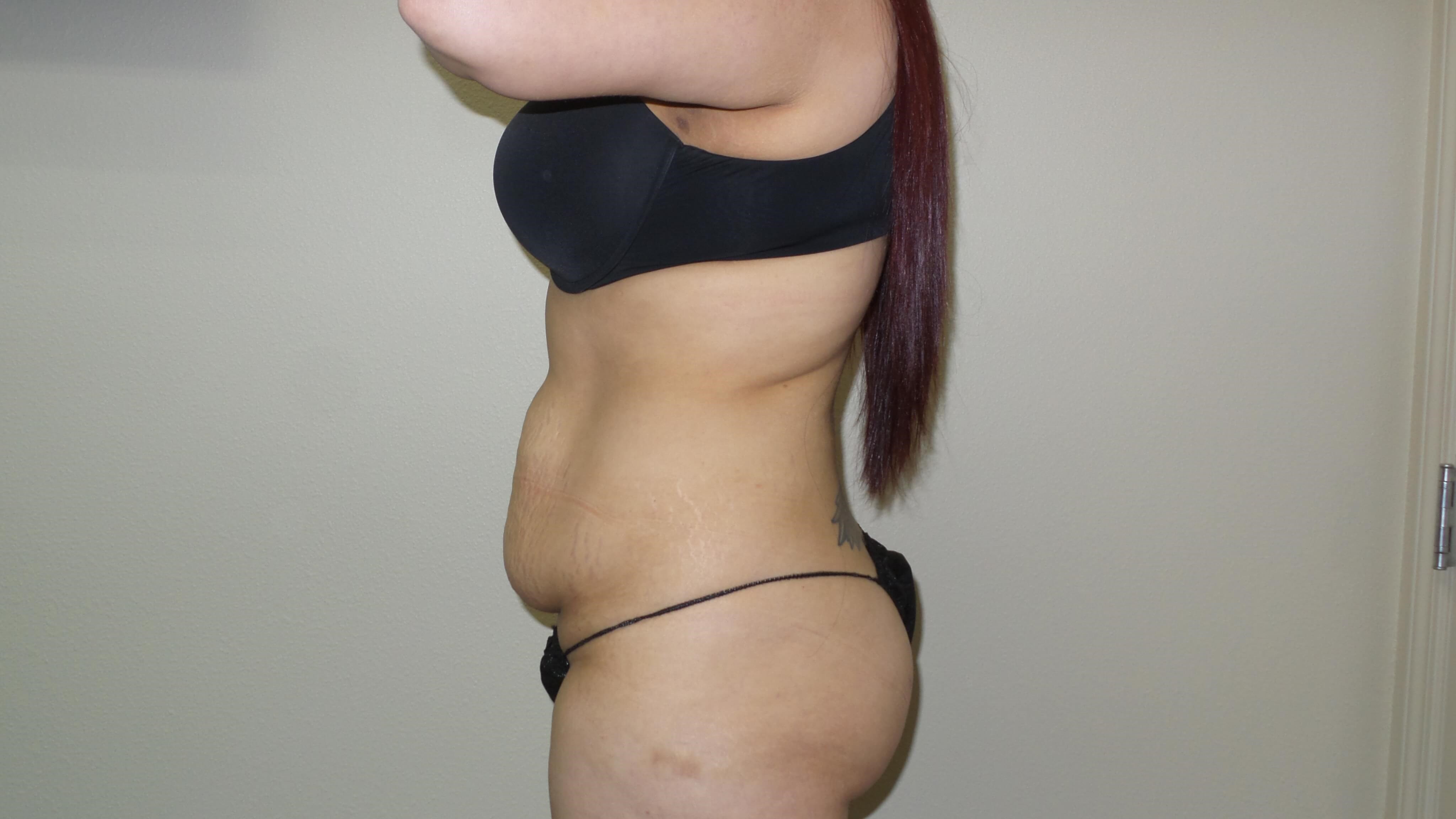 Woman Has Tummy Tuck Lipo Before