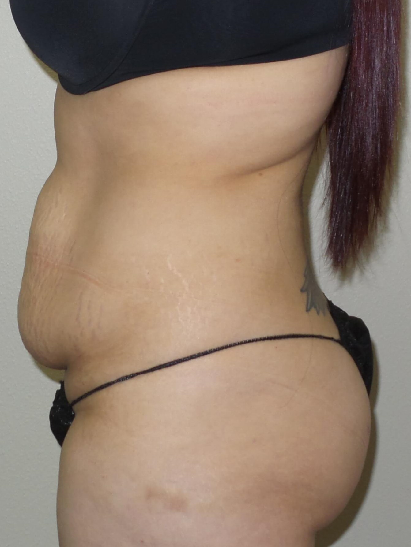 Woman Has Tummy Tuck Lipo Before