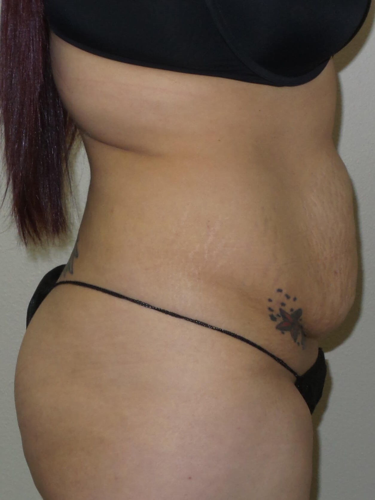 Woman Has Tummy Tuck Lipo Before