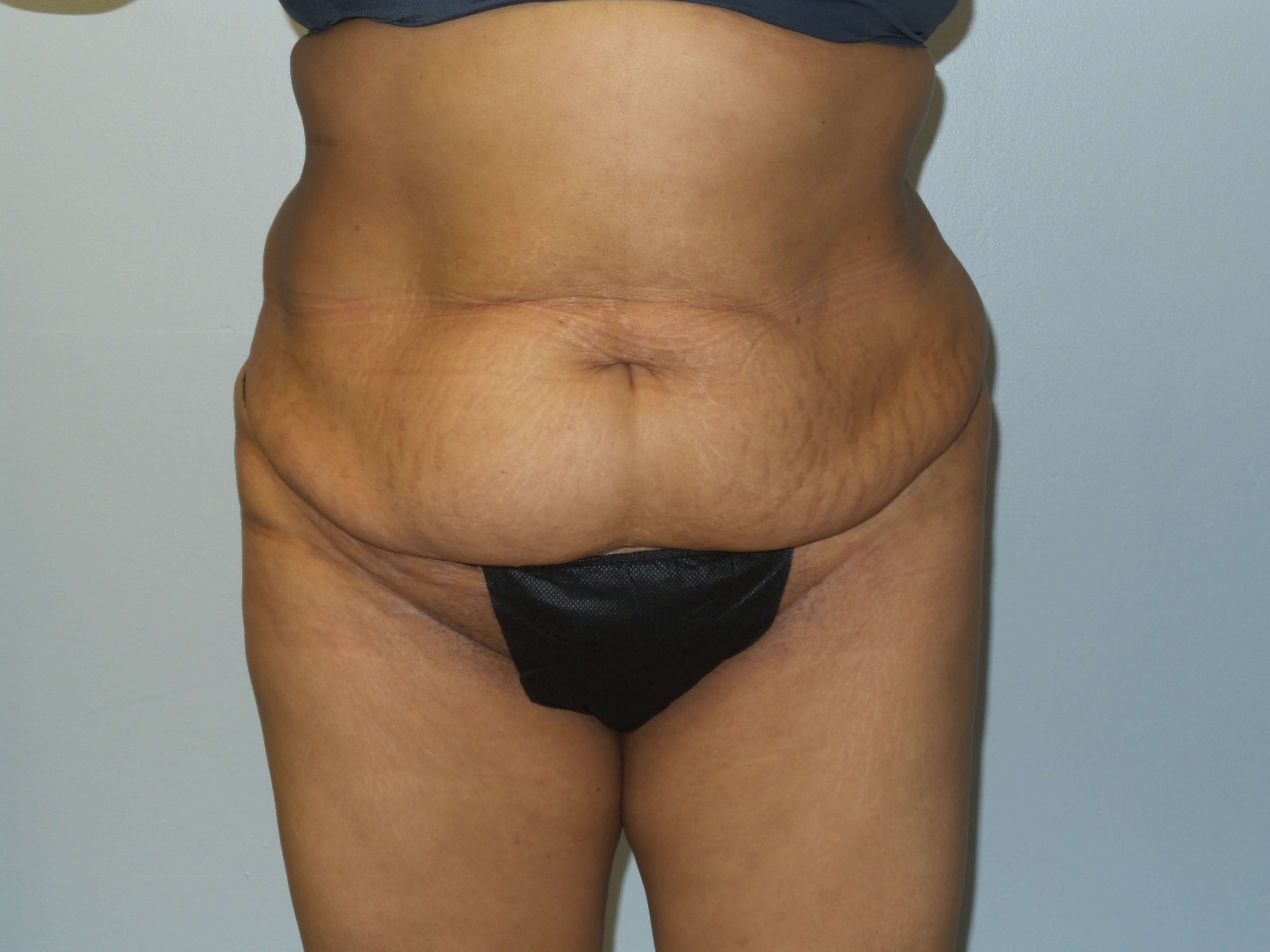 Woman Has Tummy Tuck Lipo Before