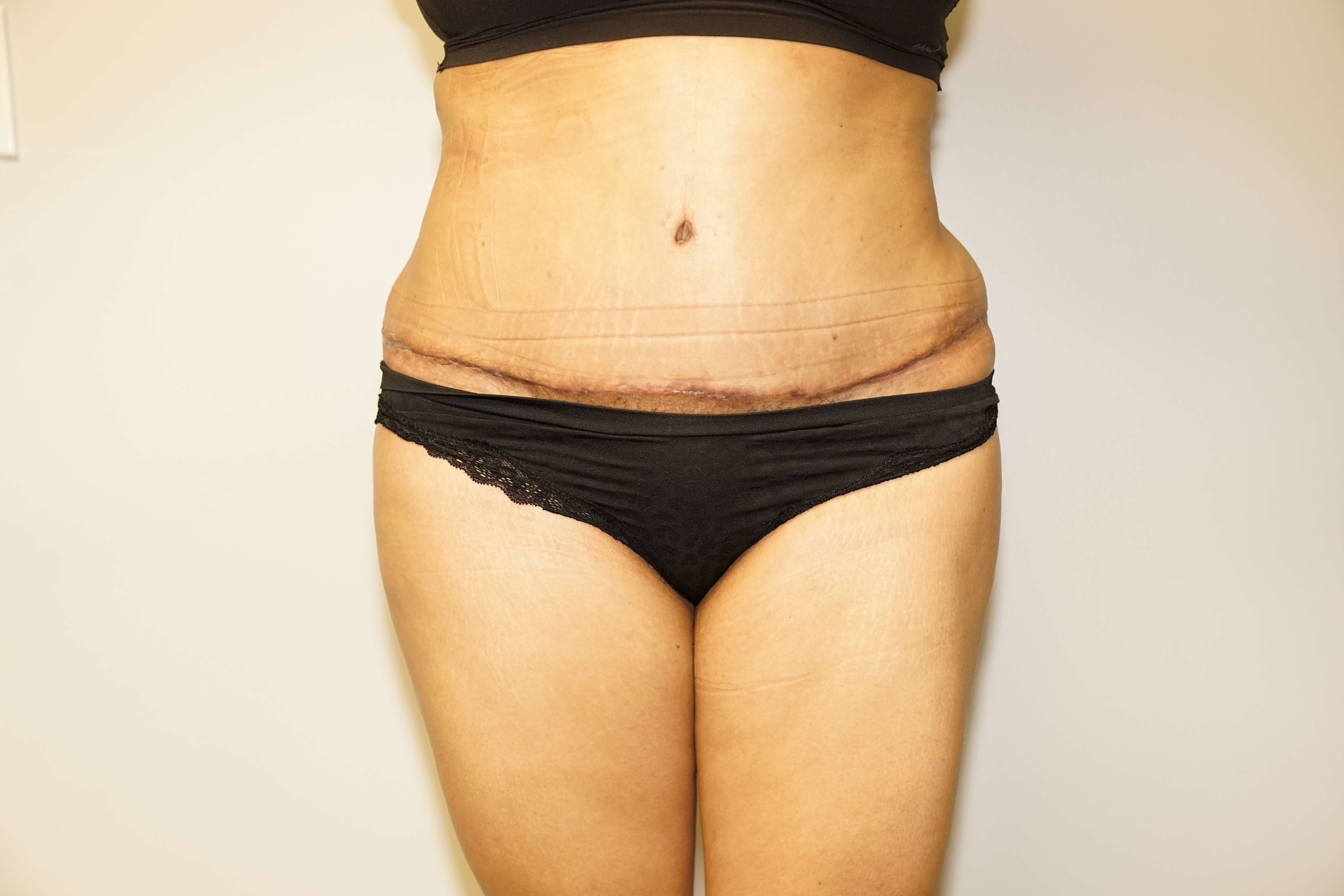 Woman Has Tummy Tuck Lipo After