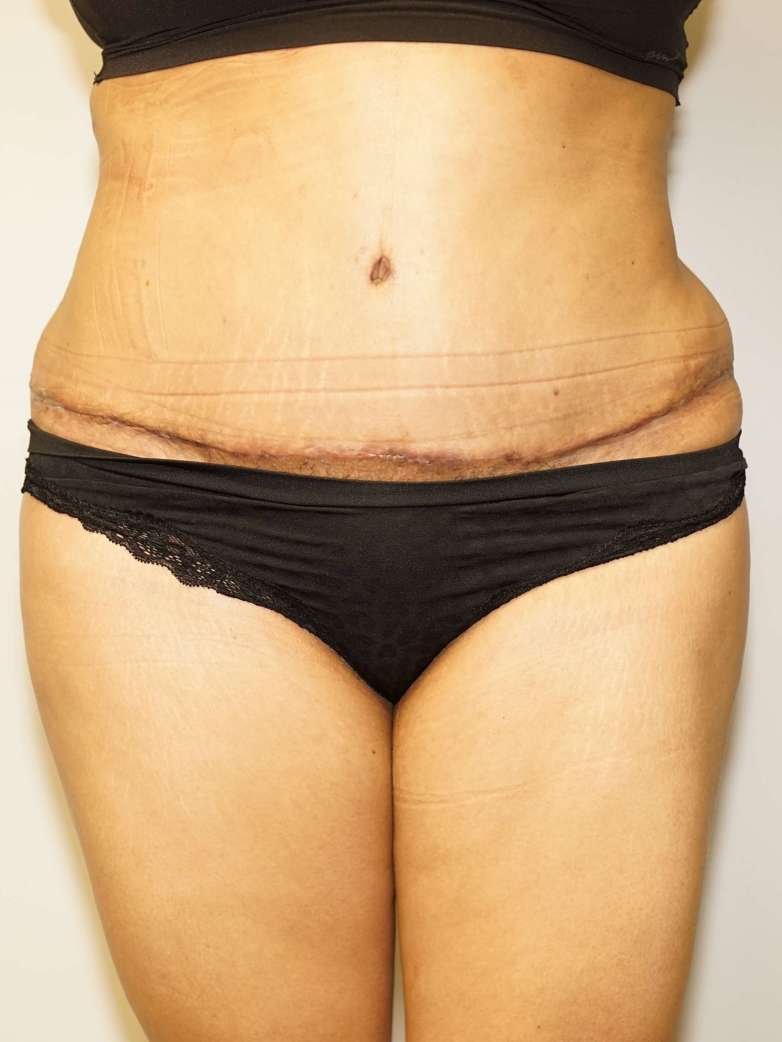 Woman Has Tummy Tuck Lipo After